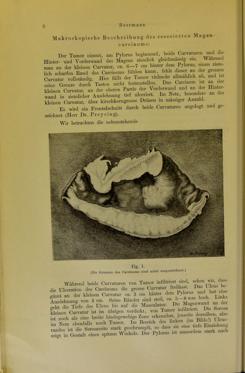 s Makroskopische Beschreibung des resecierten Magen- c arcinoms: Der Tumor nimmt, am Pylorus beginnend beide Curvaturen und die Hinter- und Vorderwand des Magens ziemlich gleichmassig ein. Wahrend man an der kleinen Curvatur, ca. 6-7 cm hinter dem Pylorus, einen ziem- lich scharfen Rand des Carcinoms fühlen kann fehlt dieser an der grossen Curvatur vollständig. Hier fällt der Tumor vielmehr aUmahhch ab und is seine Grenze durch Tasten nicht festzustellen. Das Carcinom st an dei XhW Curvatur, an der oberen Partie der Vorderwand und an der Hrnter- wandinRicher Ausdehnung tief ulceriert. Im Netz, besonders an der kleinen Curvatur, über kirschkerngrosse Drüsen in massiger Anzahl. Es wird ein Frontalschnitt durch beide Curvaturen angelegt und ge- zeichnet (Herr Dr. Preysing). Wir betrachten die nebenstehende »2 4*s Fig. 1. (Die Grenzen des Carcinoms sind nicht eingezeichnet.) Während beide Curvaturen von Tumor infiltriert sind, sehen wir dass die Ulceration des Carcinoms die grosse Curvatur freilasst. Das Ulcus be- ginnt an der kleinen Curvatur ca. 3 cm hinter dem Pylorus und hat eine Ähnung von 3 cm. Seine Ränder sind steil, ca. 5-8 mm hoch. Lmk tZ 2'Ttefe des Ulcus bis auf die Musculatur. Die Magenwand an der kSnen Cu^tur ist im übrigen verdickt, von Tumor infiltriert Die Serosa