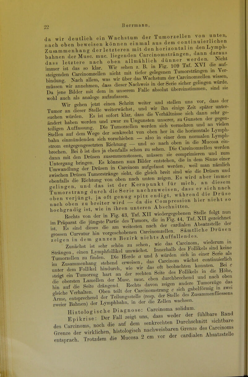 da wir deutlich ein Wachstum der Tumorzellen von unten „ach oben beweisen können einmal aus dem «ont.n«.rl.ch.» Znsammenhang der letzteren mit den horizontal in den Lymph bahnen der Mute. muc. liegenden Carcinomstrangen dann daran» dass letztere nach oben .ll.lhhck d...« » immer ist das so klar. Wir sehen z. B. in Fig. 109 Taf. XVI die aut spenden Carcinomzellen nicht mit tiefer gelegenen Tumorstrangen ,n Ver- Kndung Nach allem, was wir über das Wachstum der Carcinomzellen wissen, mütng wir annehme dass dieser Nachweis in der Serie sicher gelingen wurde. SaTne Bilder mit dem in unserem Falle absolut übereinstimmen, smd sie wohl auch als analoge aufzufassen. Wir sehen letzt einen Schritt weiter imd stellen uns vor dass der Tumor an dieser Stelle weiterwächst, und wir ihn einige Zeit spater unter- suchen würden Es ist sofort klar, dass die Verhältnisse sich dann sehr ge- ändert haben werden und zwar zuungunsten unserer, zu Gunsten der gegen- ZTnn Auffassung Die Tumorzellen werden sich vermehren und an vielen Ä aTdem Wege der senkrecht von oben her in die horizontale Lvmph- bahu einnLdendengsich vorschieben - also in ^J^IÄÄ ström entgegengesetzten Richtung — und so nach oben in die Mucosa ein brechen IT „Ist dies ja ebenfalls schon zu sehen. Die Carcinomzellen werden dann mit den D üsen 'zusammenstossen, müssen sie comprimieren und zum UnterZg Dringn. Es können nun Bilder entstehen, die in dem Sinne eine Handlung Z Drüsen in Carcinom aufgefasst werden, weil man namheh SnDJsenTnmorstränge sieht, die gleich breit smd wie, di<.Drusen und ebenfalls die Richtung von oben nach unten zeigen. Eswird aber inime gelingen und das ist der Kernpunkt für mich, an diesem fumorstranS durch die Serie nachzuweisen, dass  sich nach hochgradig ist, wie in ihren unteren Abschnitten. Rechts von der in Fig. 43, Taf. XII wiedergegebenen Stel e o gt nun im Präparat die jüngste Parüe desTumo«jto f^«^ ^^^^^7^^ Dr.... feigen in dem ganzen Bezirk nichts Auffallendes. g Zunächst ist sehr schön zu sehen, wie das CarcinomÄmn Strängen einen j^^^f^ ^en Tumorzellen zu finden. Die Herde a und b ™™e fa continuierUch ÄtteTnT=Lnhter Must Ä^h^end und nach ob, l n auf die Seite drängend Rechts davon zeigen ?£™™££P £ gleiche Verhalten. Oben te lt der Carcmomstran; e sich g*el^™Sfliessens Arme entsprechend der Teilungsstelle (resp. der Stelle des Ausam tlv Bahnen) der Lymphbahn, in der die Zellen wachsen. Histologische Diagnose: Carcinoma solidum. Snikrise Der Fall zeigt nns, dass weder der fühlbare Rand des ÄJ die ^ deni _ -J- ST Ä Ä cm vor der cardia.cn Abs—
