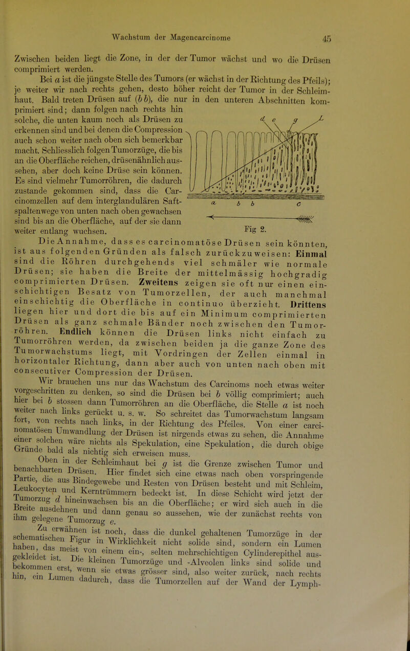 Zwischen beiden liegt die Zone, in der der Tumor wächst und wo die Drüsen comprimiert werden. Bei a ist die jüngste Stelle des Tumors (er wächst in der Richtung des Pfeils); je weiter wir nach rechts gehen, desto höher reicht der Tumor in der Schleim- haut. Bald treten Drüsen auf (b b), die nur in den unteren Abschnitten kom- primiert sind; dann folgen nach rechts hin solche, die unten kaum noch als Drüsen zu erkennen sind und bei denen die Compression . auch schon weiter nach oben sich bemerkbar i macht. Schliesslich folgen Tumorzüge, die bis an die Oberfläche reichen, drüsenähnlich aus- sehen, aber doch keine Drüse sein können. Es sind vielmehr Tumorröhren, die dadurch zustande gekommen sind, dass die Car- cinomzellen auf dem interglandulären Saft- spaltenwege von unten nach oben gewachsen sind bis an die Oberfläche, auf der sie dann weiter entlang wuchsen. DieAnnahme, dass es carcinomatös e Drüsen sein könnten, ist aus folgenden Gründen als falsch zurückzuweisen: Einmal sind die Röhren durchgehends viel schmäler wie normale Drüsen; sie haben die Breite der mittelmässig hochgradig comprimierten Drüsen. Zweitens zeigen sie oft nur einen ein- schichtigen Besatz von Tumorzellen, der auch manchmal einschichtig die Oberfläche in continuo überzieht. Drittens liegen hier und dort die bis auf ein Minimum comprimierten Drusen als ganz schmale Bänder noch zwischen den Tumor- röhren. Endlich können die Drüsen links nicht einfach zu Tumorröhren werden, da zwischen beiden ja die ganze Zone des lumorwachstums liegt, mit Vordringen der Zellen einmal in horizontaler Richtung, dann aber auch von unten nach oben mit consecutiver Compression der Drüsen. Wir brauchen uns nur das Wachstum des Carcinoms noch etwas weiter vorgeschritten zu denken, so sind die Drüsen bei b völlig comprimiert; auch hier bei b stossen dann Tumorröhren an die Oberfläche, die Stelle a ist noch weiter nach links gerückt u. s. w. So schreitet das Tumorwachstum langsam tort, yon rechts nach links, in der Richtung des Pfeiles. Von einer carci- nomatosen Umwandlung der Drüsen ist nirgends etwas zu sehen, die Annahme einer solchen wäre nichts als Spekulation, eine Spekulation, die durch obige Grunde bald als nichtig sich erweisen muss. 8 vTT m^der Schleimhaut bei g ist die Grenze zwischen Tumor und Denachbarten Drüsen. Hier findet sich eine etwas nach oben vorspringende tJIL f aus^degewebe und Resten von Drüsen besteht und mit Schleim, TW 7T .Kerntrümmern bedeckt ist. In diese Schicht wird jetzt der lumoizug hineinwachsen bis an die Oberfläche; er wird sich auch in die ^geÄ^ geDaU S° aUSSeheD' ^ ^ ZUnäch8t reGhtS VOn schema^Lr.Wa^en iSt nZcK daSS die dunkel Seltenen Tumorzüge in der hfltn FlgUr m Wirklichkeit nicht solide sind, sondern ein Lumen eSet ttmen- Vm einem 6in'' Selten mehrschichtigen Cylinderepithel aus- Ckommen L Wn Tumorzüge und Alveolen links sind solide und * ™ ' TT 8Je etwas Srösser sind' also weiter zurück> nach rechts nm, ein Lumen dadurch, dass die Tumorzellen auf der Wand der Lymph-
