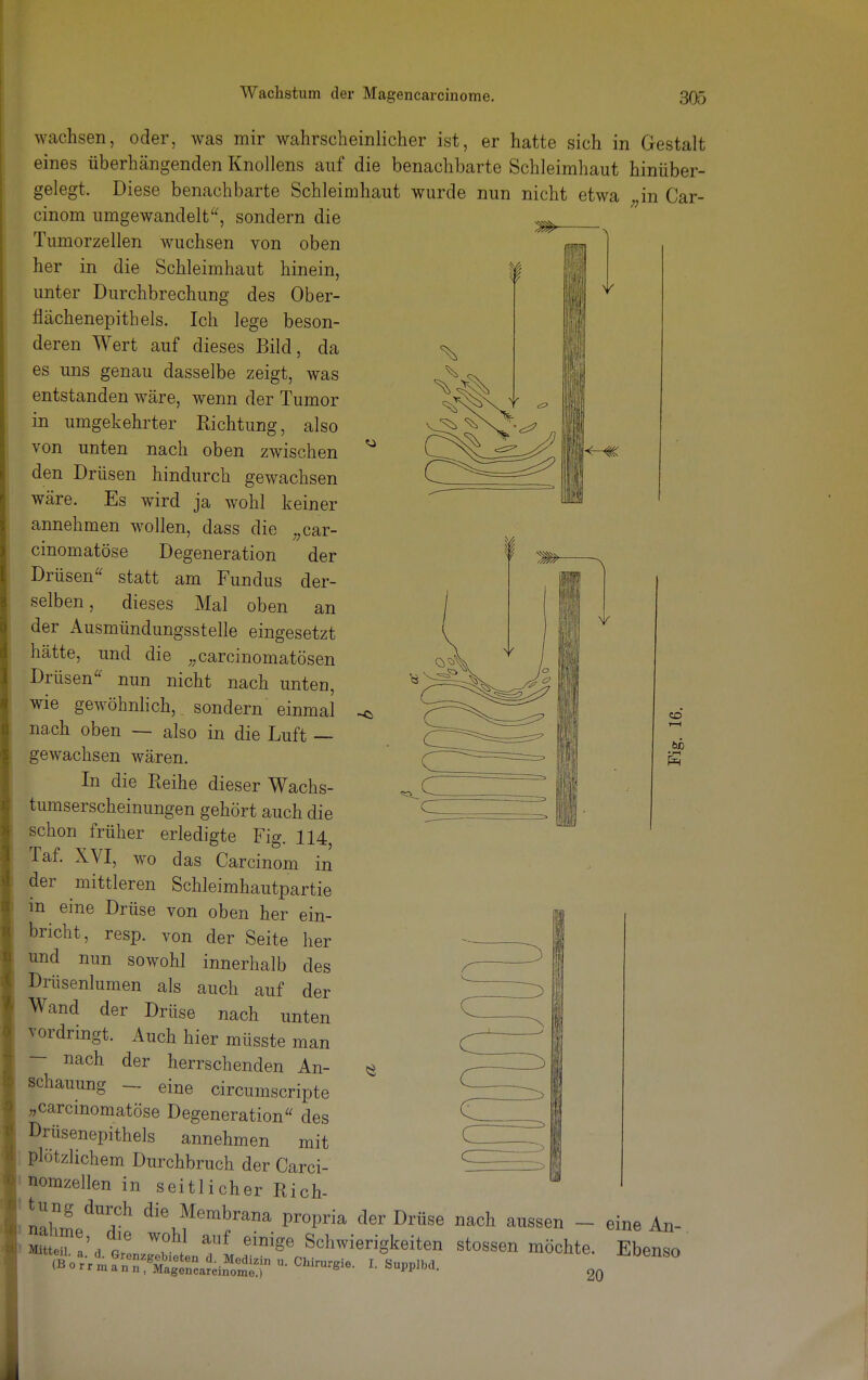 S //// wachsen, oder, was mir wahrscheinlicher ist, er hatte sich in Gestalt eines überhängenden Knollens auf die benachbarte Schleimhaut hinüber- gelegt. Diese benachbarte Schleimhaut wurde nun nicht etwa ;;in Car- cinom umgewandelt', sondern die Tumorzellen wuchsen von oben her in die Schleimhaut hinein, unter Durchbrechung des Ober- flächenepithels. Ich lege beson- deren Wert auf dieses Bild, da es uns genau dasselbe zeigt, was entstanden wäre, wenn der Tumor in umgekehrter Richtung, also von unten nach oben zwischen ^ den Drüsen hindurch gewachsen wäre. Es wird ja wohl keiner annehmen wollen, dass die „car- cinomatöse Degeneration der Drüsen statt am Fundus der- selben, dieses Mal oben an der Ausmündungsstelle eingesetzt hätte, und die „carcinomatösen Drüsen nun nicht nach unten, wie gewöhnlich, sondern einmal ^ nach oben — also in die Luft — gewachsen wären. In die Reihe dieser Wachs- tumserscheinungen gehört auch die schon früher erledigte Fig. 114, Taf. XVI, wo das Carcinom in der mittleren Schleimhautpartie m eine Drüse von oben her ein- bricht, resp. von der Seite her und nun sowohl innerhalb des Drüsenlumen als auch auf der Wand der Drüse nach unten vordringt. Auch hier müsste man — nach der herrschenden An- $ schauung - eine circumscripte „carcmomatöse Degeneration des Drüsenepithels annehmen mit plötzlichem Durchbruch der Carci- nomzellen in seitlicher Rich- tung durch die Membrana propria der Drüse nach aussen - eine An- SH'.t^ einige Schwierigkeiten Stessen möchte. Ebenso (B.rri;?^^^*^ U. Chirurgie. I. Supp,bd. CO r—I ÖD 5