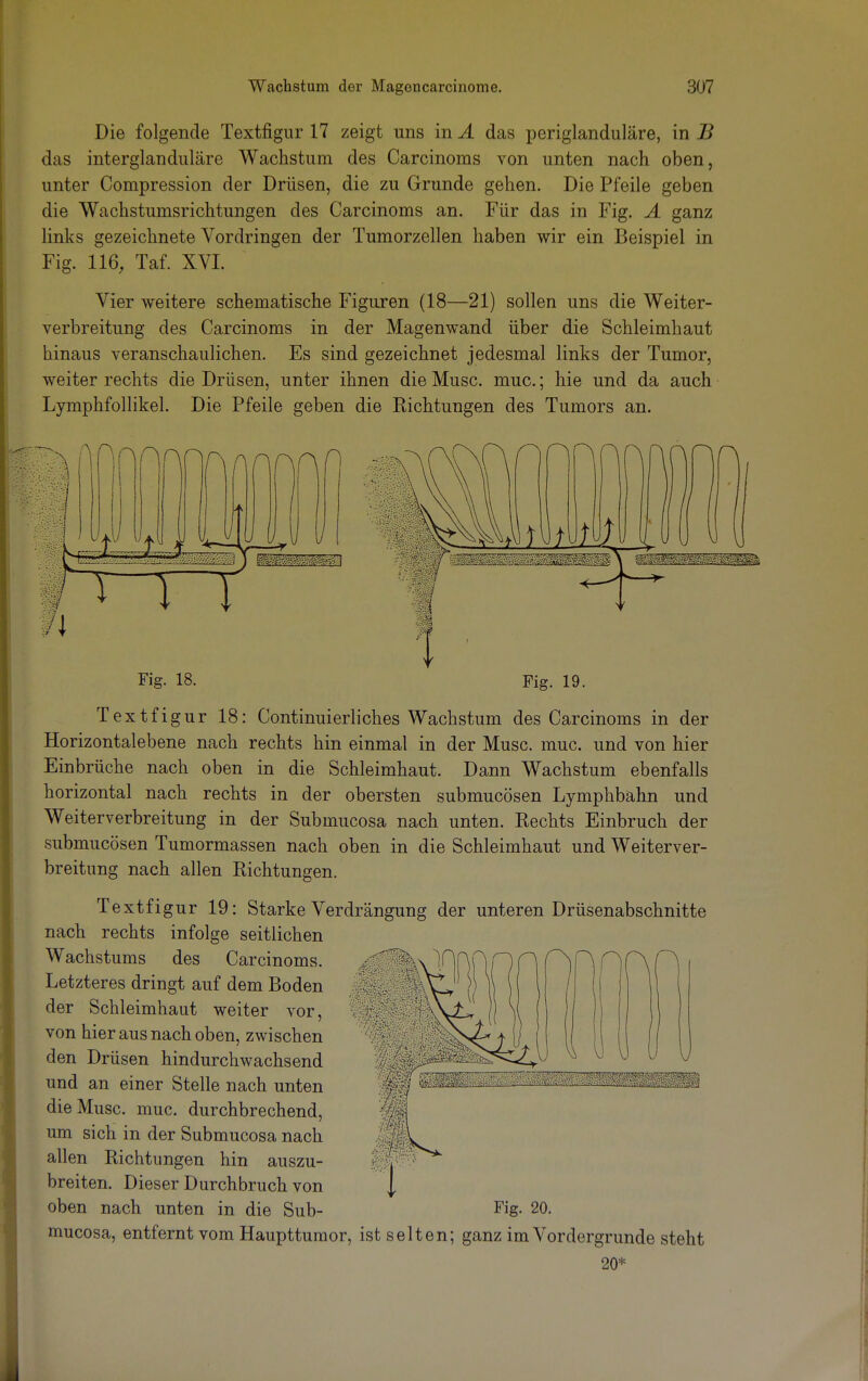 Die folgende Textfigur 17 zeigt uns in A das periglanduläre, in B das interglanduläre Wachstum des Carcinoms von unten nach oben, unter Compression der Drüsen, die zu Grunde gehen. Die Pfeile geben die Wachstumsrichtungen des Carcinoms an. Für das in Fig. A ganz links gezeichnete Vordringen der Tumorzellen haben wir ein Beispiel in Fig. 116, Taf. XVI. Vier weitere schematische Figuren (18—21) sollen uns die Weiter- verbreitung des Carcinoms in der Magenwand über die Schleimhaut hinaus veranschaulichen. Es sind gezeichnet jedesmal links der Tumor, weiter rechts die Drüsen, unter ihnen die Muse. muc.; hie und da auch Lymphfollikel. Die Pfeile geben die Richtungen des Tumors an. I w m Fig. 18. 1 Fig. 19. Textfigur 18: Continuierliches Wachstum des Carcinoms in der Horizontalebene nach rechts hin einmal in der Muse. muc. und von hier Einbrüche nach oben in die Schleimhaut. Dann Wachstum ebenfalls horizontal nach rechts in der obersten submucösen Lymphbahn und Weiterverbreitung in der Submucosa nach unten. Rechts Einbruch der submucösen Tumormassen nach oben in die Schleimhaut und Weiterver- breitimg nach allen Richtungen. Textfigur 19: Starke Verdrängung der unteren Drüsenabschnitte nach rechts infolge seitlichen Wachstums des Carcinoms. Letzteres dringt auf dem Boden der Schleimhaut weiter vor, von hier aus nach oben, zwischen den Drüsen hindurchwachsend und an einer Stelle nach unten die Muse. muc. durchbrechend, um sich in der Submucosa nach allen Richtungen hin auszu- breiten. Dieser Durchbruch von oben nach unten in die Sub- Fig. 20. mueosa, entfernt vom Haupttumor, ist selten; ganz im Vordergrunde steht 20*