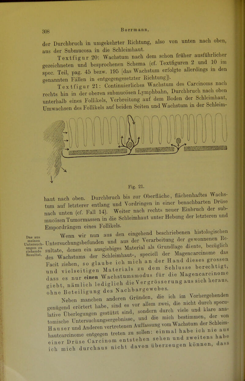 der Durchbrach in umgekehrter Richtung, also von unten nach oben, aus der Submucosa in die Schleimhaut. Textfigur 20: Wachstum nach dem schon früher ausfuhrlicher gezeichneten und besprochenen Schema (cf. Textfiguren 2 und 10 im spec. Teil, pag. 45 bezw. 195 [das Wachstum erfolgte allerdings m den genannten Fällen in entgegengesetzter Richtung]). Textfigur 21: Continuierliches Wachstum des Carcmoms nach rechts hin in der oberen submucösen Lymphbahn, Durchbruch nach oben unterhalb eines Follikels, Verbreitung auf dem Boden der Schleimhaut, Umwachsen des Follikels auf beiden Seiten und Wachstum m der Schleim- Fig. 21. haut nach oben. Durchbruch bis zur Oberfläche, nachenhaftes Wachs- tum auf letzterer entlang und Vordringen in einer benachbarten Druse „ich nnten (cf Fall 14). Weiter nach rechts neuer Einbruch der sub- mncösen Tumormassen in die Schleimhaut unter Hebung der letzteren und Empordrängen eines Follikels. Wenn wir nun aus den eingehend beschriebenen histologischen u=SV Untersuchungsbefunden nnd aus der Verarbeitung der gewonnenen Re- SSM snltate, denen ein ansgiebiges Material ^^^^X: omT ^ ™ des Wachstums der Schleimhaut- speciell der Mage— Facit ziehen, so glaube ich mich an der Hand d'e.e. gi<»ssen nnd vielseitigen Materials zu dem Schlüsse berechtigt dass e nur eilen Wachstnmsmodns für die Magencarcmome gieU nämlich lediglich die Vergrößerung aus sich heraus, ohne Beteiligung des Nachbargewebes. Neben manchen anderen Gründen, die ich im Vorhergehenden genügend Trörtert habe, sind es vor allem zwei die nicht durch specu- genugenu eiu , sondern durch viele und klare ana- Hl mich durchaus nicht davcn überzeugen können, dass