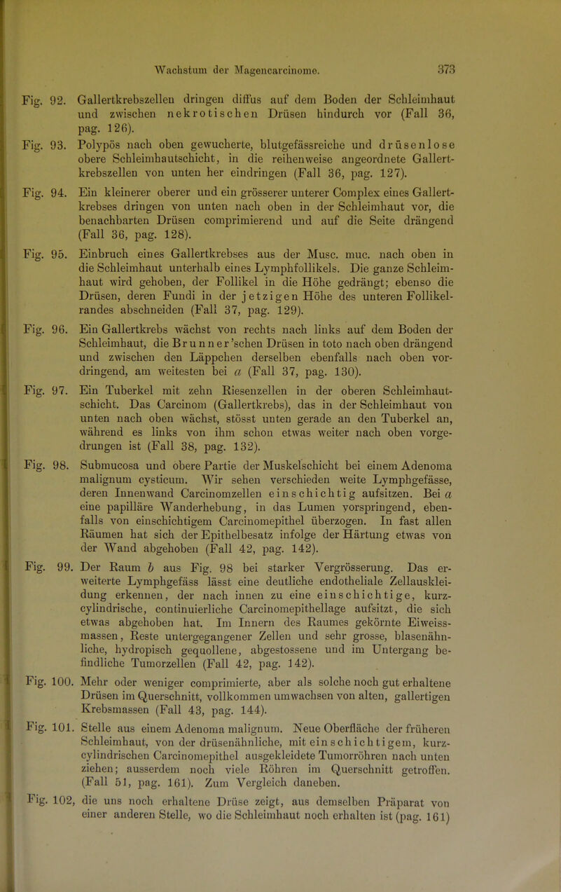 Fig. 92. Gallertkrebszelleu dringen diffus auf dem Boden der Schleimhaut und zwischen nekrotischen Drüsen hindurch vor (Fall 36, pag. 126). Fig. 93. Polypös nach oben gewucherte, blutgefässreiche und drüsenlose obere Schleimhautschicht, in die reihenweise angeordnete Gallert- krebszellen von unten her eindringen (Fall 36, pag. 127). Fig. 94. Ein kleinerer oberer und ein grösserer unterer Complex eines Gallert- krebses dringen von unten nach oben in der Schleimhaut vor, die benachbarten Drüsen comprimierend und auf die Seite drängend (Fall 36, pag. 128). Fig. 95. Einbruch eines Gallertkrebses aus der Muse. muc. nach oben in die Schleimhaut unterhalb eines Lymphfollikels. Die ganze Schleim- haut wird gehoben, der Follikel in die Höhe gedrängt; ebenso die Drüsen, deren Fundi in der jetzigen Höhe des unteren Follikel - randes abschneiden (Fall 37, pag. 129). Fig. 96. Ein Gallertkrebs wächst von rechts nach links auf dem Boden der Schleimhaut, die Br u n n e r 'sehen Drüsen in toto nach oben drängend und zwischen den Läppchen derselben ebenfalls nach oben vor- dringend, am weitesten bei a (Fall 37, pag. 130). Fig. 97. Ein Tuberkel mit zehn Riesenzellen in der oberen Schleimhaut- schicht. Das Carcinom (Gallertkrebs), das in der Schleimhaut von unten nach oben wächst, stösst unten gerade an den Tuberkel an, während es links von ihm schon etwas weiter nach oben vorge- drungen ist (Fall 38, pag. 132). Fig. 98. Submucosa und obere Partie der Muskelschicht bei einem Adenoma malignum cysticum. Wir sehen verschieden weite Lymphgefässe, deren Innenwand Carcinomzellen einschichtig aufsitzen. Bei a eine papilläre Wanderhebung, in das Lumen vorspringend, eben- falls von einschichtigem Carcinomepithel überzogen. In fast allen Räumen hat sich der Epithelbesatz infolge der Härtung etwas von der Wand abgehoben (Fall 42, pag. 142). Fig. 99. Der Raum b aus Fig. 98 bei starker Vergrösserung. Das er- weiterte Lymphgefäss lässt eine deutliche endotheliale Zellausklei- dung erkennen, der nach innen zu eine einschichtige, kurz- cylindrische, continuierliche Carcinomepithellage aufsitzt, die sich etwas abgehoben hat. Im Innern des Raumes gekörnte Eiweiss- massen, Reste untergegangener Zellen und sehr grosse, blasenähn- liche, hydropisch gequollene, abgestossene und im Untergang be- findliche Tumorzellen (Fall 42, pag. 142). Fig. 100. Mehr oder weniger comprimierte, aber als solche noch gut erhaltene Drüsen im Querschnitt, vollkommen umwachsen von alten, gallertigen Krebsmassen (Fall 43, pag. 144). Fig. 101. Stelle aus einem Adenoma malignum. Neue Oberfläche der früheren Schleimhaut, von der drüsenähnliche, mit einschichtigem, kurz- cylindrischen Carcinomepithel ausgekleidete Tuniorröhren nach unten ziehen; ausserdem noch viele Röhren im Querschnitt getroffen. (Fall 51, pag. 161). Zum Vergleich daneben. Fig. 102, die uns noch erhaltene Drüse zeigt, aus demselben Präparat von einer anderen Stelle, wo die Schleimhaut noch erhalten ist (pag. 161)