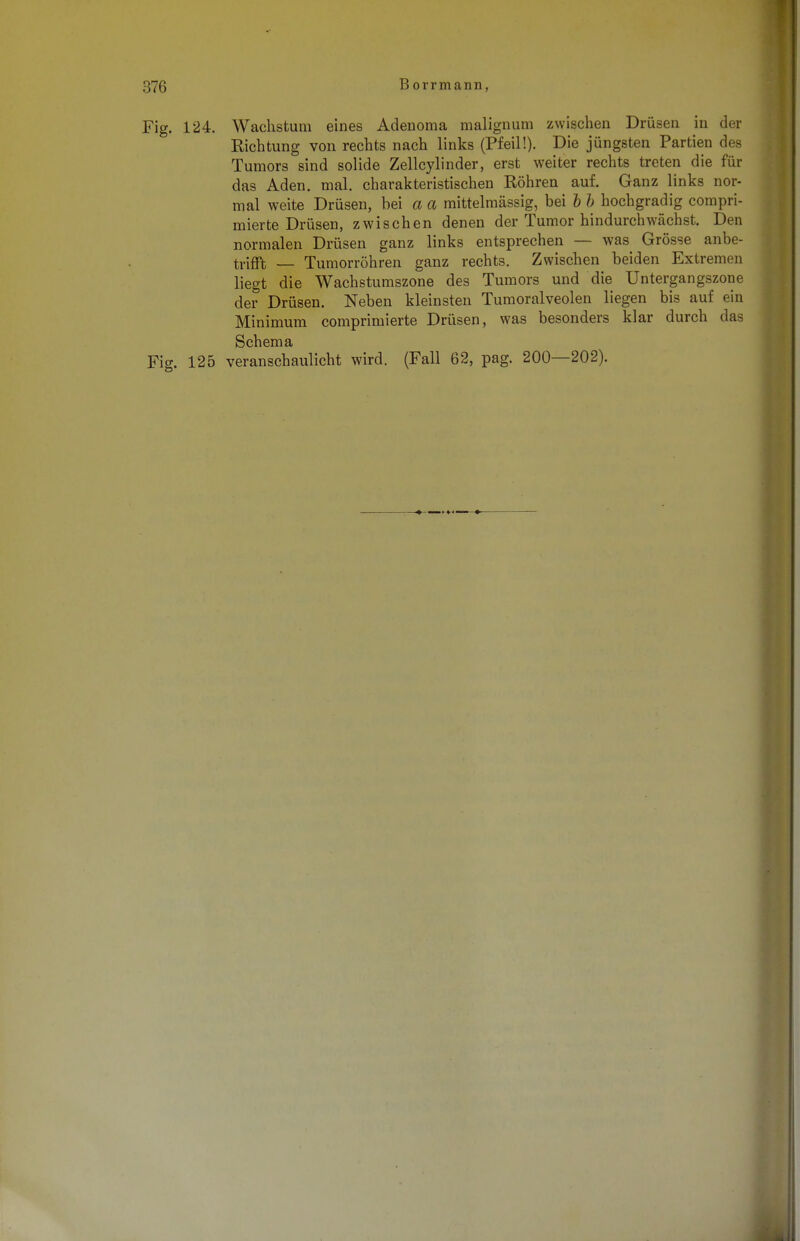 Fig. 124. Wachstum eines Adenoma malignum zwischen Drüsen in der Richtung von rechts nach links (Pfeil!). Die jüngsten Partien des Tumors sind solide Zellcylinder, erst weiter rechts treten die für das Aden. mal. charakteristischen Röhren auf. Ganz links nor- mal weite Drüsen, bei a a mittelmässig, bei b b hochgradig compri- mierte Drüsen, zwischen denen der Tumor hindurchwächst. Den normalen Drüsen ganz links entsprechen — was Grösse anbe- trifft — Tumorröhren ganz rechts. Zwischen beiden Extremen liegt die Wachstumszone des Tumors und die Untergangszone der Drüsen. Neben kleinsten Tumoralveolen liegen bis auf ein Minimum comprimierte Drüsen, was besonders klar durch das Schema