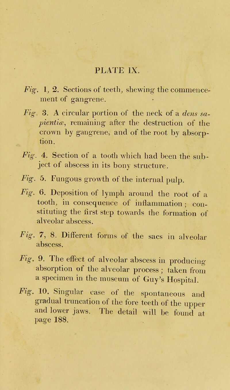 Fig. I, 2. Sections of teeth^ shewing the commence- ment of gangrene. Fig. 3. A circular portion of the neck of a de7is sa- pienti(s, remaining after the destruction of the crown by gangrene, and of the root by absorp- tion. Fig. 4. Section of a tooth which had been the sub- ject of abscess in its bony structure. Fig. 5. Fungous growth of the internal pulp. Fig. 6. Deposition of lymph around the root of a tooth, in consequence of inflammation; con- stituting the first step towards the formation of alveolar abscess. Fig. 7, 8. Different forms of the sacs in alveolar abscess. Fig. 9. The effect of alveolar abscess in producing absorption of the alveolar process; taken from a specimen in the museum of Guy's Hospital. Fig. 10. Singular case of the spontaneous and gradual truncation of the fore teeth of the upper and lower jaws. The detail will be found at page 188.
