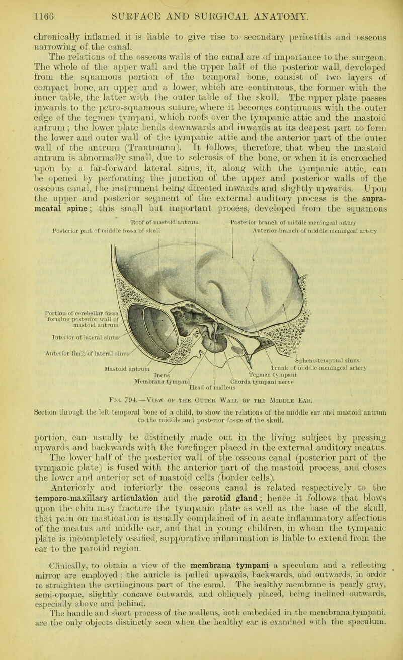 chronically inflamed it is liable to give rise to secondary periostitis and osseous narrowing of the canal. The relations of the osseous walls of the canal are of importance to the surgeon. The whole of the upper wall and the upper half of the posterior wall, developed from the squamous portion of the temporal bone, consist of two layers of compact bone, an upper and a lower, which are continuous, the former with the inner table, the latter with the outer table of the skull. The upper plate passes inwards to the petro-squamous suture, where it becomes continuous with the outer edge of tlie tegmen tympani, which roofs over the tympanic attic and the mastoid antrum; the lower plate bends downwards and inwards at its deepest part to form the lower and outer wall of the tympanic attic and the anterior part of the outer wall of the antrum (Trautmann). It follows, therefore, that when the mastoid antrum is abnormally small, due to sclerosis of the bone, or when it is encroached upon by a far-forward lateral sinus, it, along with the tympanic attic, can be opened by perforating the junction of the upper and posterior walls of the osseous canal, the instrument being directed inwards and slightly upwards. Upon the upper and posterior segment of the external auditory process is the supra- meatal spine; this small but important })rocess, developed from the squamous Roof of iiiastoiil autruin Posterior branch of middle meningeal artery Po.sterior part of middle fnssa of skull i ] Anterior branch of niid(ile meningeal artery Membrana tympani | Chorda tympani nerve Head of malleus Fki. 794.—View of the Odter Wall of the Middle Eau. Section tlirough the left temporal l)one of a child, to show the relations of the middle ear and mastoid antrum to the nnddle and posterior foss£e of the skull. portion, can usually be distinctly made out in the living subject by pressing upwards and liackwards with the forefinger placed in the external auditory meatus. The lower half of the posterior wall of the osseous canal (posterior part of the tympanic plate) is fused with the anterior part of the mastoid procesS; and closes tlie lower and anterior set of mastoid cells (border cells). Anteriorly and interiorly the osseous canal is related respectively to the temporo-maxillary articulation and the parotid gland; hence it follows that blows upon the chin may fracture the tympanic plate as well as the base of the skull, that pain on mastication is usually complained of in acute inflammatory affections of the meatus and middle ear, and that in young children, in whom the tympanic plate is incompletely ossified, suppurative inflammation is liable to extend from the ear to the parotid region. Chnically, to obtain a view of the membrana tympani a specuUuii and a reflecting mirror are employed : tlie auricle is pulled upwards, backwards, and outwards, in order to straighten the cartilaginous part of tiie canal. The healthy membrane is pearly gray, semi-opaque, slightly concave outwards, and obliquely placed, being inclined outwards, especially above and behind. The handle and short process of the malleus, both embedded in the membrana tympani, are the only objects distinctly seen when the healthy ear is examined with the speculum.