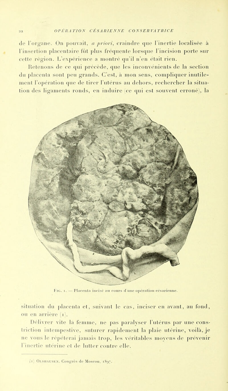 de l'organe. On pouvait, a priori, craindre que l'inertie localisée à l'insertion placentaire fiit plus fréquente lorsque l'incision porte sur cette région. L'expérience a montré qu'il n'en était rien. Retenons de ce qui précède, que les inconvénients de la section du placenta sont peu grands. C'est, à mon sens, compliquer inutile- ment l'opération que de tirer l'utérus au dehors, rechercher la situa- tion des ligaments ronds, en induire (ce qui est souvent erroné), la Fie. 1. — Pliirpiila iiifisO nu fours d niio uppriitioii résariciinc. silualion du placenla el, suivanl le cas, inciser en avant, au i'ond, ou en arrière (i). Délivi'er vite la femme, ne pas paralyseï' l'iiléi iis par une cons- triction intenq:)cstive, suturer lapidcmoiit la plaie utérine, voilà, je ne vous le répcUerai jamais trop, les vérilahles movens de prévenir l'inertie utérine el de lutter contre^ cWc. il) Oi.siiAUSKN. Coiif^i-os de Moscou. iSi);