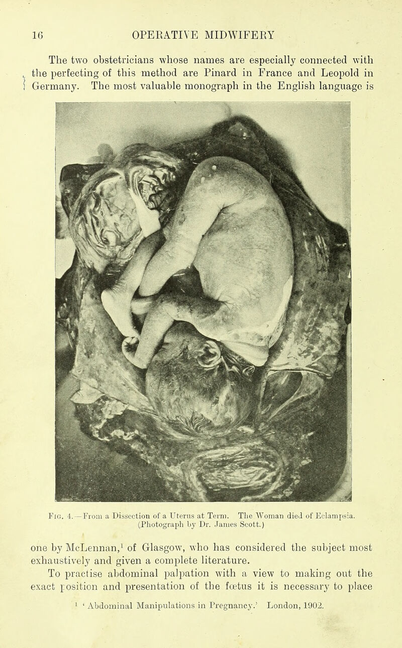 The two obstetricians whose names are especially connected with . the perfecting of this method are Pinard in France and Leopold in i Germany. The most valuable monograph in the English language is Fig. 4. —From a Dissection of a Uterus at Term. The Woman died of Eclampsia. (Photograph by Dr. James Scott.) one by McLennan/ of Glasgow, who has considered the subject most exhaustively and given a complete literature. To practise abdominal palpation with a view to making out the exact ]:osition and presentation of the fa?tus it is necessary to place ' ' Abdominal Manipulations in Pregnancy.' London, 1902.