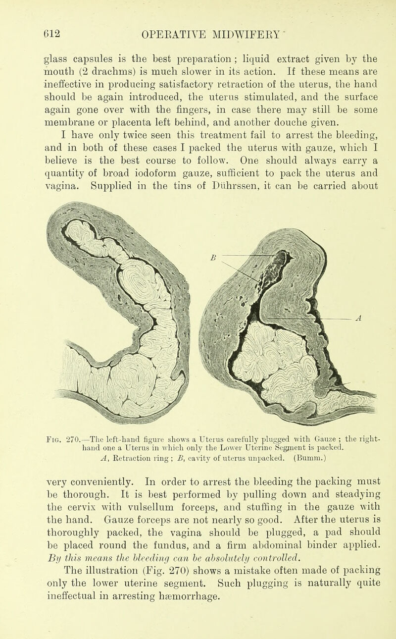 glass capsules is the best preparation ; liquid extract given by the mouth ('2 drachms) is much slower in its action. If these means are ineffective in producing satisfactory retraction of the uterus, the hand should be again introduced, the uterus stimulated, and the surface again gone over with the fingers, in case there may still be some membrane or placenta left behind, and another douche given. I have only twice seen this treatment fail to arrest the bleeding, and in both of these cases I packed the uterus with gauze, which I believe is the best course to follow. One should always carry a quantity of broad iodoform gauze, sufficient to pack the uterus and vagina. Supplied in the tins of Diihrssen, it can be carried about Fig. 270.—The left-hand figure shows a Uterus carefully plugged with Gauze ; the right- hand one a Uterus in which only the Lower Uterine Segment is packed. A, Ketraction ring ; B, oaidty of uterus unpacked. (Bumm.) very conveniently. In order to arrest the bleeding the packing must be thorough. It is best performed by pulling down and steadying the cervix with vulsellum forcejjs, and stuffing in the gauze with the hand. Gauze forceps are not nearly so good. After the uterus is thoroughly packed, the vagina should be plugged, a pad should be placed round the fundus, and a firm abdominal binder applied. By this means the hleediufi can be ahsolatehj controlled. The illustration (Fig. 270) shows a mistake often made of packing only the lower uterine segment. Such plugging is naturally quite ineffectual in arresting haemorrhage.