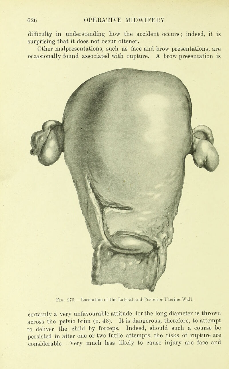 difficulty in understanding how the accident occurs ; indeed, it is surprising that it does not occur oftener. Other malpresentations, such as face and brow i^resentations, are occasionally found associated with rupture. A brow presentation is Fig. 275.—Laceration of the Lateral and Posterior Uterine WaU. certainly a very unfavourable attitude, for the long diameter is thrown across the pelvic brim (p. 43). It is dangerous, therefore, to attempt to deliver the child by forceps. Indeed, should such a course be persisted in after one or two futile attempts, the risks of rupture are considerable. Very much less likely to cause injury are face and