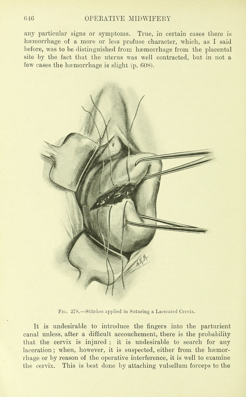 any particular signs or symptoms. True, in certain cases there is haemorrhage of a more or less profuse character, which, as I said before, was to be distinguished from haemorrhage from the placental site by the fact that the uterus was well contracted, but in not a few cases the hfemorrhage is slight (p. 608). Fig. 278.—Stitches applied in Suturing a Lacerated Cervix. It is undesirable to introduce the fingers into the parturient canal unless, after a difficult accouchement, there is the probability that the cervix is injured ; it is undesirable to search for any laceration; when, however, it is suspected, either from the haemor- rhage or by reason of the operative interference, it is well to examine the cervix. This is best done by attaching vulsellum forceps to the