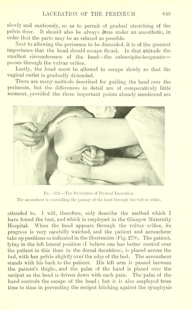 slowly and eautiousljs so as to permit of gradual stretching of the pelvic floor. It should also be ahvays done under an antesthetic, in order that the parts may be as relaxed as possible. Next to allowing the perineum to be distended, it is of the greatest importance that the head should escape flexed. In that a,ttitude the smallest circumference of the head—the suboecipito-bregmatic— passes through the vulvar oriflce. Lastly, the head must be allowed to escape slowly so that the vaginal outlet is gradually distended. There are many methods described for guiding the head over the perineum, but the differences in detail are of comparatively little moment, provided the three important points already mentioned are Fiii. 279.—The Pri'vention of Perineal Laceration. Tire aceoircheur is controlling the passage of the head through the vulvar orifice. attended to. I will, therefore, only describe the method which I have found the l)est, and which is employed in the Glasgow Maternity Hospital. When the head appears through the vulvar orifice, its progress is very carefully watched, and the patient and accoucheur take up positions as indicated in the illustration (Fig. 279). The patient, lying in the left lateral position (I believe one has better control over the patient in this than in the dorsal decubitus), is placed across the bed, with her pelvis slightly over the edge of the bed. The accoucheur stands with his back to the patient. His left arm is passed between the patient's thighs, and the palm of the hand is placed over the occiput as the head is driven down with each pain. The palm of the hand controls the escape of the head ; but it is also employed from time to time in preventing the occiput hitching against the symphysis