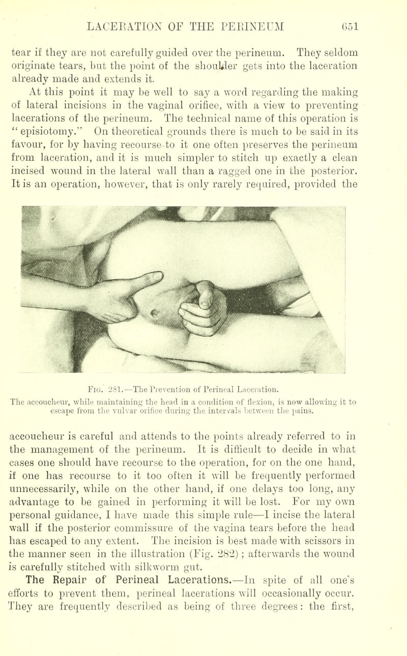 tear if they are not carefully guided over the perineum. They seldom originate tears, but the point of the shouUler gets into the laceration already made and extends it. At this point it may be well to say a word regarding the making of lateral incisions in the vaginal orifice, with a view to preventing lacerations of the perineum. The technical name of this operation is  episiotomy. On theoretical grounds there is much to be said in its favour, for by having recourse-to it one often preserves the perineum from laceration, and it is much simpler to stitch up exactly a clean incised wound in the lateral wall than a ragged one in the posterior. It is an operation, however, that is only rarely required, provided the Fig. 281.—The Prevention of Perineal Laceration. The accoueheur, while maintaining the liead in a condition of flexion, is now allowing it to escape from the vulvar orifice during the inter\'als between the pains. accoucheur is careful and attends to the points already referred to in the management of the perineum. It is difficult to decide in what cases one should have recourse to the operation, for on the one hand, if one has recourse to it too often it will be frequently performed unnecessarily, while on the other hand, if one delays too long, any advantage to be gained in performing it will be lost. For my own personal guidance, I liuve made this simple rule—I incise the lateral wall if the posterior commissure of the vagina tears before the head has escaped to any extent. The incision is best made with scissors in the manner seen in the illustration (Fig. '2S2); afterwards the wound is carefully stitched with silkworm gut. The Repair of Perineal Lacerations.—In spite of all one's efforts to prevent them, perineal lacerations will occasionally occur. They are frequently descriljed as being of three degrees: the first,