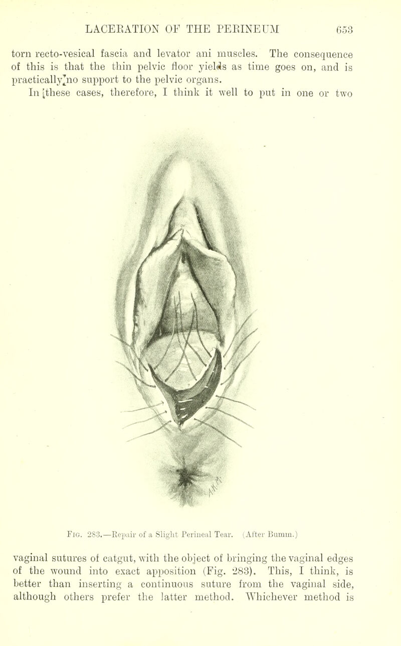 torn recto-vesical fascia and levator ani muscles. The consequence of this is that the thin pelvic floor yielcJs as time goes on, and is practically^no support to the pelvic organs. In [these cases, therefore, I think it well to put in one or two Fig. 283.—Ileii;iir of a Slight Perineal Tear. (After Bumm.) vaginal sutures of catgut, with the object of bringing the vaginal edges of the wound into exact apposition (Fig. '283), This, I think, is better than inserting a continuous suture from the vaginal side, although others prefer the latter method. Whichever method is