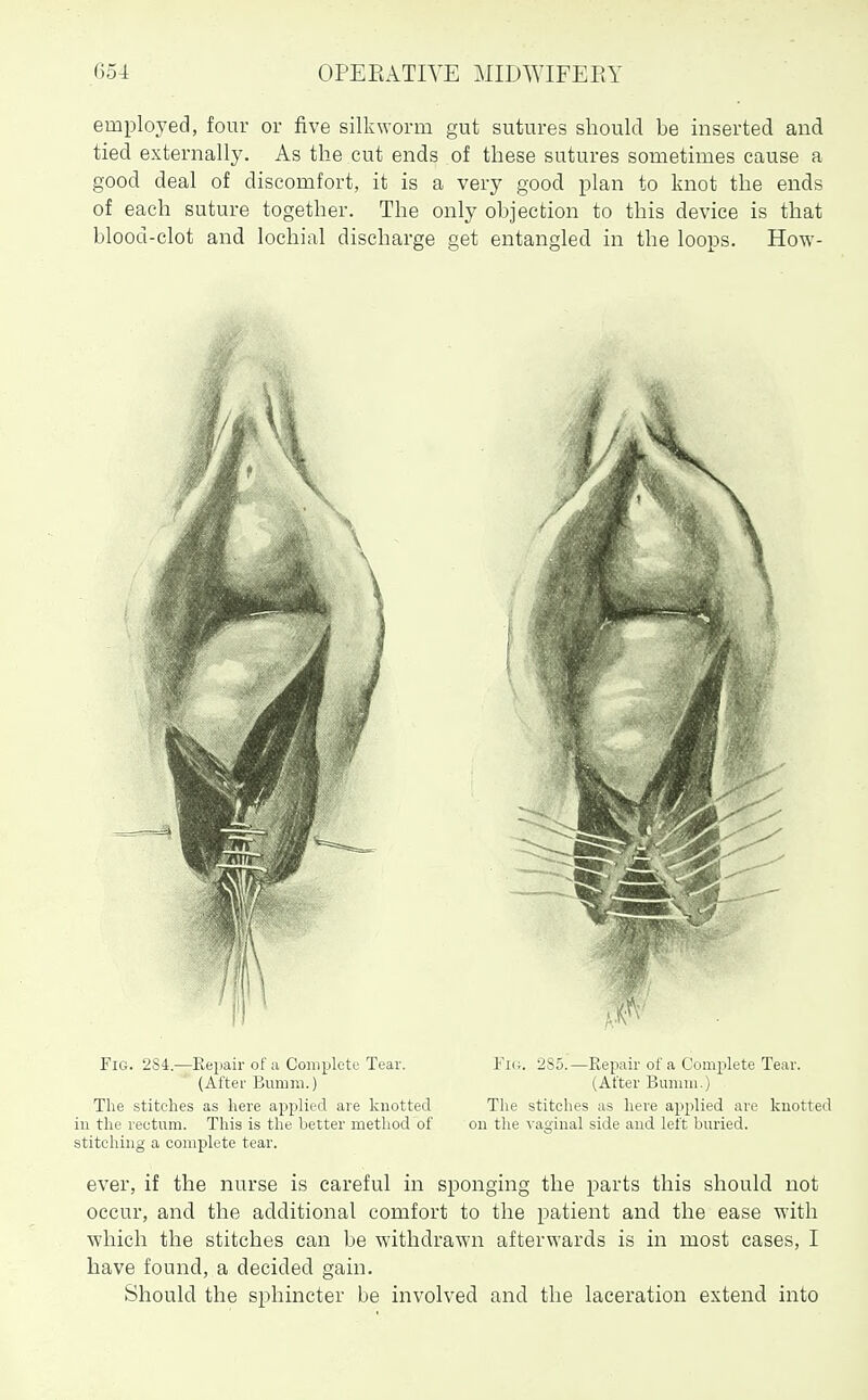 employed, four or five silkworm gut sutures should be inserted and tied externally. As the cut ends of these sutures sometimes cause a good deal of discomfort, it is a very good plan to knot the ends of each suture together. The only objection to this device is that blood-clot and lochial discharge get entangled in the loops. How- ever, if the nurse is careful in sponging the parts this should not occur, and the additional comfort to the patient and the ease with ■which the stitches can be withdrawal afterwards is in most cases, I have found, a decided gain. Should the sphincter be involved and the laceration extend into