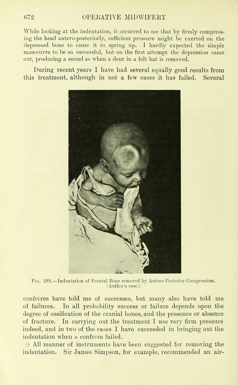 While looking at the indentation, it occurred to me that by iirmly compress- ing the head antero-posteriorly, sufficient pressure might be exerted on the depressed bone to cause it to spring up. I hardly expected the simple manoeuvre to be so successful, but on the first attempt the depression came out, producing a sound as when a dent in a felt hat is removed. During recent years I have had several equally good results from this treatment, although in not a few cases it has failed. Several Fig. 289.—Indentation of Frontal Bone removed by Antero-Posterior Compression. (Author's case.) confreres have told me of successes, but many also have told me of failures. In all probability success or failure depends upon the degree of ossification of the cranial bones, and the presence or absence of fracture. In carrying out the treatment I use very firm pressure indeed, and in two of the cases I have succeeded in bringing out the indentation when a confrere failed. •3 All manner of instruments have been suggested for removing the indentation. Sir James Simpson, for example, recommended an air-