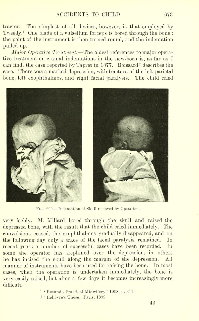 tractor. The simplest of all devices, however, is that emploj'ed by Tweedy.^ One blade of a vulsellum forceps is bored through the bone ; the point of the instrument is then turned round, and the indentation pulled up. Major Operative Treatment.—The oldest references to major opera- tive treatment on cranial indentations in the new-born is, as far as I can find, the case reported by Tapret in 1877. Boissard-' describes the case. There was a marked depression, with fracture of the left parietal bone, left exophthalmos, and right facial paralysis. The child cried Fig. 290.—Indentation of JSkull removed by Operation. very feebly. M. Millard bored through the skull and raised the depressed bone, with the result that the child cried immediately. The convulsions ceased, the exophthalmos gradually disajipeared, and on the following day only a trace of the facial paralysis remained. In recent years a number of successful cases have been recorded. In some the operator has trephined over the depression, in others he has incised the skull along the margin of the depression. All manner of instruments have been used for raising the bone. In most cases, when the operation is undertaken immediately, the bone is very easily raised, but after a few days it becomes increasingly more difficult. 1 ' Rotunda Practical Midwifery,' 1908, p. 311. 2 ' Lelievre's These,' Paris, 1892. 43
