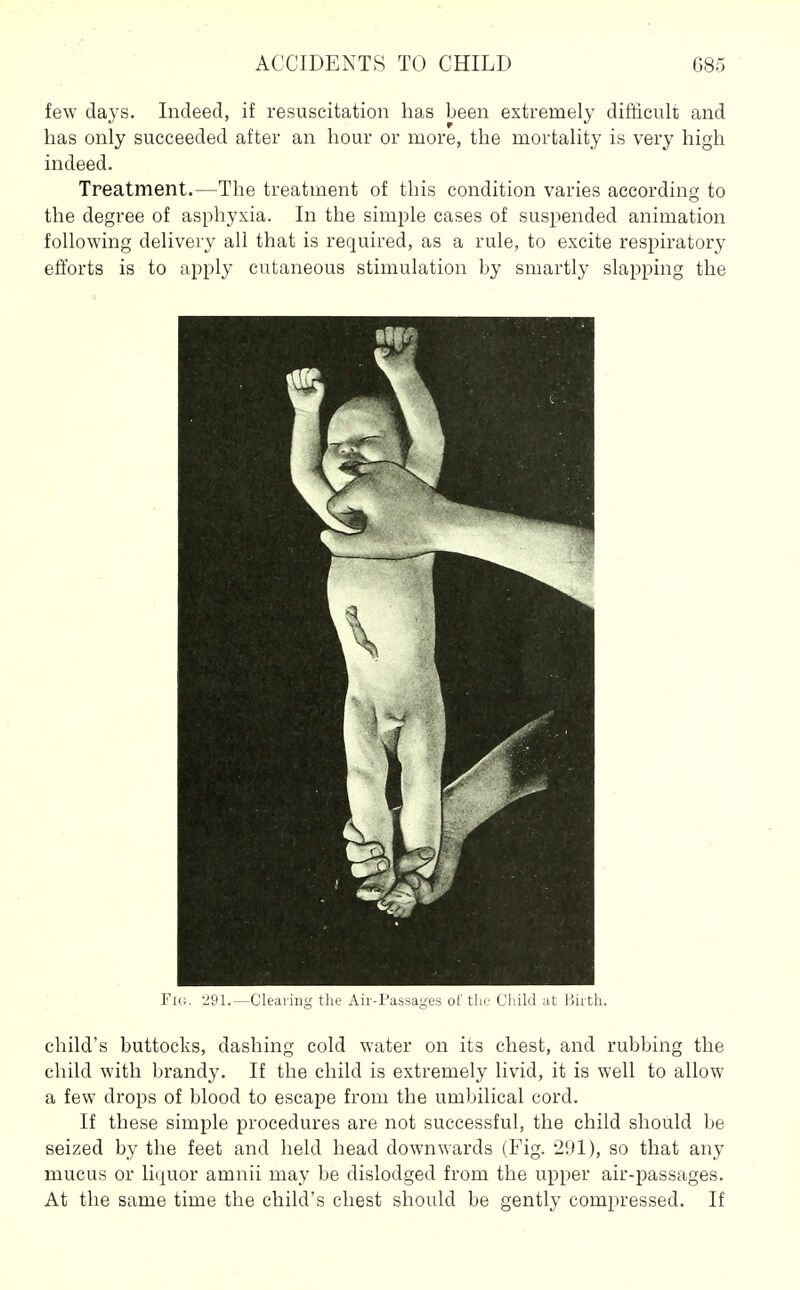 few days. Indeed, if resuscitation has been extremely difficult and has only succeeded after an hour or more, the mortality is very high indeed. Treatment.—The treatment of this condition varies according to the degree of asphyxia. In the simple cases of suspended animation following delivery all that is required, as a rule, to excite respiratory efforts is to apply cutaneous stimulation by smartly slapping the Fk;. -^Ol.—Cleaiing the Air-Passages of the Cliild at Hirth. child's buttocks, dashing cold water on its chest, and rubbing the child with brandy. If the child is extremely livid, it is well to allow a few drops of blood to escape from the umbilical cord. If these simple procedures are not successful, the child should be seized by the feet and held head downwards (Fig. 291), so that any mucus or liquor amnii may be dislodged from the upper air-passages. At the same time the child's chest should be gently compressed. If