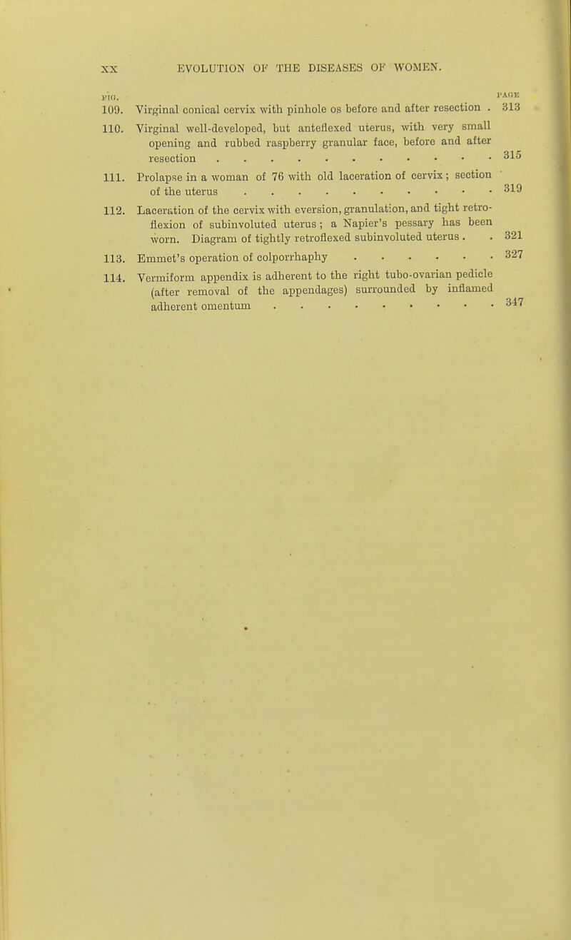 via l'AOK 109. Virginal conical cervix with pinhole os before and after resection . 313 110. Virginal well-developed, but antefiexed uterus, with very small opening and rubbed raspberry granular face, before and after resection . 315 111. Prolapse in a woman of 76 with old laceration of cervix; section of the uterus 319 112. Laceration of the cervix with eversion, granulation, and tight retro- flexion of subinvoluted uterus ; a Napier's pessary has been worn. Diagram of tightly retroflexed subinvoluted uterus . . 321 113. Emmet's operation of colporrhaphy 327 114. Vermiform appendix is adherent to the right tubo-ovarian pedicle (after removal of the appendages) surrounded by inflamed adherent omentum 317