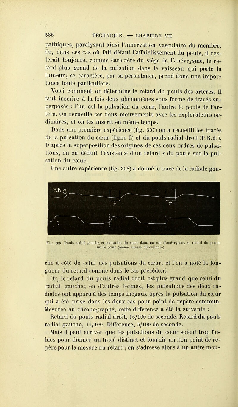 pathiques, paralysant ainsi l'innervation vasculaire du membre. Or, dans ces cas où fait défaut l'aifaiblissement du pouls, il res- terait toujours, comme caractère du siège de l'anévrysme, le re- tard plus grand de la pulsation dans le vaisseau qui porte la tumeur; ce caractère, par sa persistance, prend donc une impor- tance toute particulière. Voici comment on détermine le retard du pouls des artères. Il faut inscrire à la fois deux phénomènes sous forme de tracés su- perposés : l'un est la pulsation du cœur, l'autre le pouls de l'ar- tère. On recueille ces deux mouvements avec les explorateurs or- dinaires, et on les inscrit en même temps. Dans une première expérience (fig. 307) on a recueilli les tracés de la pulsation du cœur (ligne G) et du pouls radial droit (P.R.d.). D'après la superposition des origines de ces deux ordres de pulsa- tions, on en déduit l'existence d'un retard r du pouls sur la pul- sation du cœur. Une autre expérience (flg. 308) a donné le tracé de la radiale gau- —- h K r ' i' Fig. 308. Pouls radial gauche, et pulsation du cœur dans un cas d'anévrysme. r, retard du puuls sur le cœur (même vitesse du cylindre). che à côté de celui des pulsations du cœur, et l'on a noté la lon- gueur du retard comme dans le cas précédent. Or, le retard du pouls radial droit est plus grand que celui du radial gauche; en d'autres termes, les pulsations des deux ra- diales ont apparu à des temps inégaux après la pulsation du cœur qui a été prise dans les deux cas pour point de repère commun. Mesurée au chronographe, cette différence a été la suivante : Retard du pouls radial droit, 16/100 de seconde. Retard du pouls radial gauche, 11/100. Différence, 5/100 de seconde. Mais il peut arriver que les pulsations du cœur soient trop fai- bles pour donner un tracé distinct et fournir un bon point de re- père pour la mesure du retard; on s'adresse alors à un autre mou-
