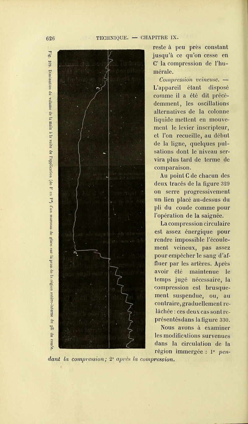 reste à peu près constant jusqu'à ce qu'on cesse en C la compression de l'hu- mérale. Compression veineuse. — L'appareil étant disposé comme il a été dit précé- demment, les oscillations alternatives de la colonne liquide mettent en mouve- ment le levier inscripteur, et l'on recueille, au début de la ligne, quelques pul- sations dont le niveau ser- vira plus tard de terme de comparaison. Au point G de chacun des deux tracés de la figure 329 on serre progressivement un lien placé au-dessus du pli du coude comme pour l'opération de la saignée. La compression circulaire est assez énergique pour rendre impossible l'écoule- ment veineux, pas assez pour empêcher le sang d'af- fluer par les artères. Après avoir été maintenue le temps jugé nécessaire, la compression est brusque- ment suspendue, ou, au contraire,graduellement re- lâchée : ces deux cas sont re- présentés dans la figure 330. Nous avons à examiner les modifications survenues dans la circulalion de la région immergée : 1° pen- dant la compression; 2 après la compression.
