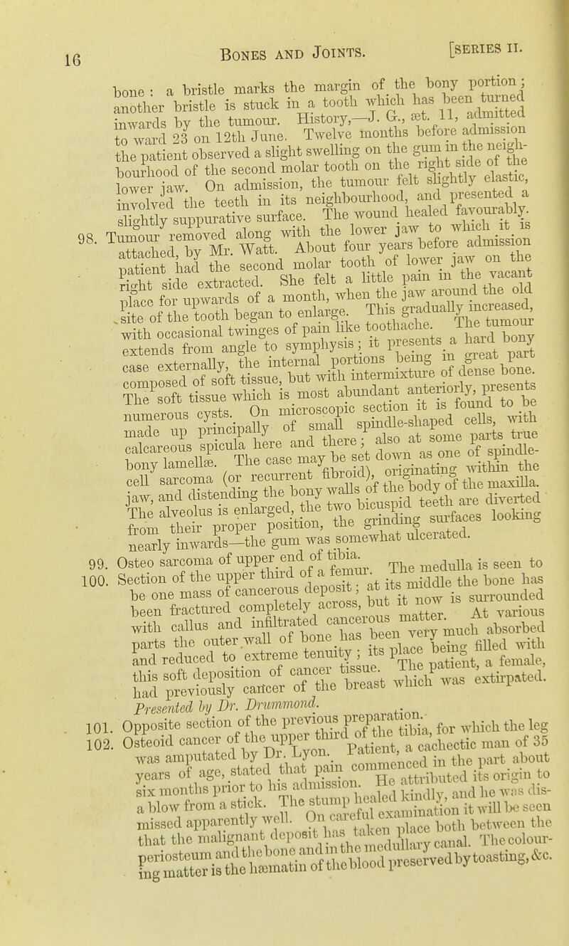 Q Bones and Joints. [series it. bone : a bristle marks the margin of _ the bony portion; another bristle is stuck in a tooth whjch 1- --^^^^^^^^^^ inwards by the tumonr. History—J. G., ^et 11, to wml 23 on 12th June. Twelve months before admission the pat ent observed a shght swelling on the guni m the neigh louSood of the second molar tooth on ^1- rig^^^^^^^^^ lower iaw. On admission, the tumour felt shghtly elastic involved the teeth in its neighbourhood, and presented a s^tly su]Surative surface. The wound ^^^^^^ ^^fl with occasional twinges of pani like tootliacha J^c 'umom extends from angle to symphysis l iM'f' «f ^^l^ ' '^SttsufrlirSmS^^ S':o1t\;'srwSS\'most ahnndant a^^^^^^^^ . ^^^^^ hsz be one mass of cancerous deposit f ^^^^^^^^^^ surrounded been fractured completely across, but it now b S callus and ^^^brenTe^ much a^^^^^^^^ Presented hy Dr. Drummond. 101. Opposite section of the previoiisprepa^^^^^^^ for wldch the leg 02. Osteoid cancer of the upper ^lurd of the t^bm^^^^^^ 3^ was amputated by Dr Lyon._ P/^J^,^^^'^^^^^^ part about years of age, stated that pain ^^^^^^X^^^^^^ j , origin to six months prior to his admission. He ^^ti ™t;^ - a^low from'a stick. The stump ^^^^^^