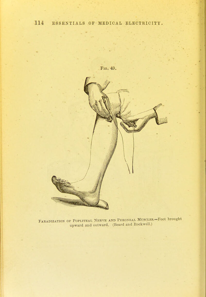 Fig. 49. Faradization of Popliteal Nerve and Peroneal MuscLES.-Foot brought upward and outward. (Beard and Rockwell.)