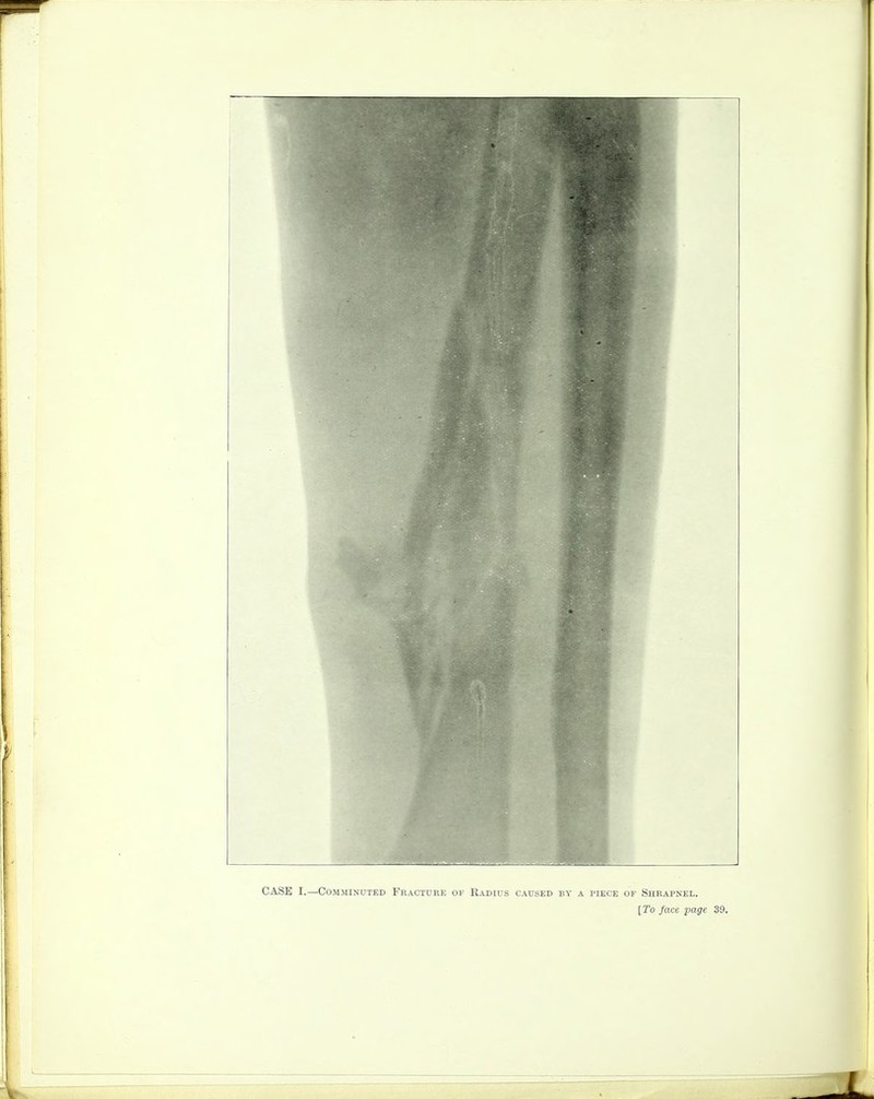 CASE I.—Comminuted Fracture of Radius caused by a piece op Shrapnel.