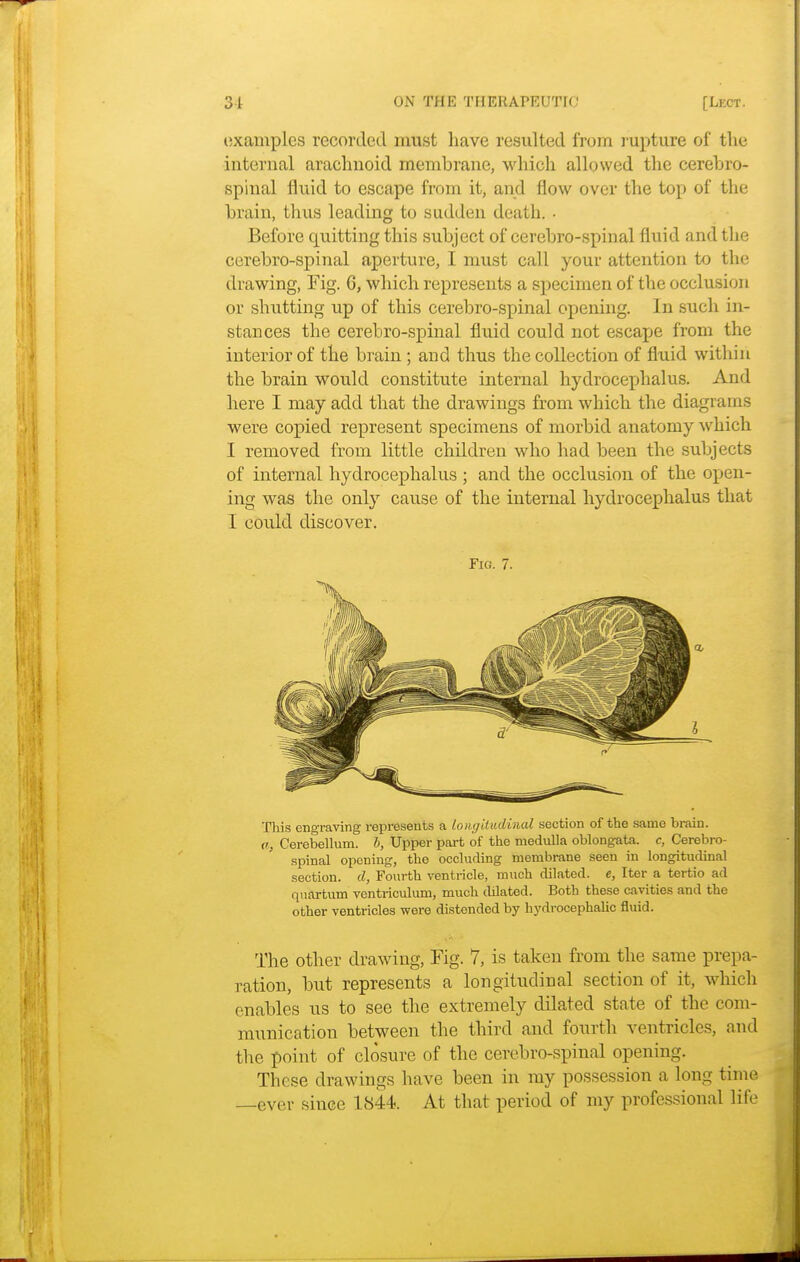 examples recorded must have resulted from rupture of the internal arachnoid membrane, which allowed the cerebro- spinal fluid to escape from it, and flow over the top of the brain, thus leading to sudden death. • Before quitting this subject of cerebro-spinal fluid and the cerebro-spinal aperture, I must call your attention to the drawing, Fig. 6, which represents a specimen of the occlusion or shutting up of this cerebro-spinal opening. In such in- stances the cerebro-spinal fluid could not escape from the interior of the brain ; and thus the collection of fluid within the brain would constitute internal hydrocephalus. And here I may add that the drawings from which the diagrams were copied represent specimens of morbid anatomy which I removed from little children who had been the subjects of internal hydrocephalus ; and the occlusion of the open- ing was the only cause of the internal hydrocephalus that I could discover. Fig. 7. This engraving represents a longitudinal section of the same brain. a, Cerebellum, b, Upper part of the medulla oblongata, c, Cerebro- spinal opening, the occluding membrane seen in longitudinal section, d, Fourth ventricle, much dilated, e, Iter a tertio ad quartum ventriculum, much dilated. Both these cavities and the other ventricles were distended by hydrocephalic fluid. The other drawing, Fig. 7, is taken from the same prepa- ration, but represents a longitudinal section of it, which enables us to see the extremely dilated state of the com- munication between the third and fourth ventricles, and the point of closure of the cerebro-spinal opening. These drawings have been in my possession a long time —ever since 1844. At that period of my professional life