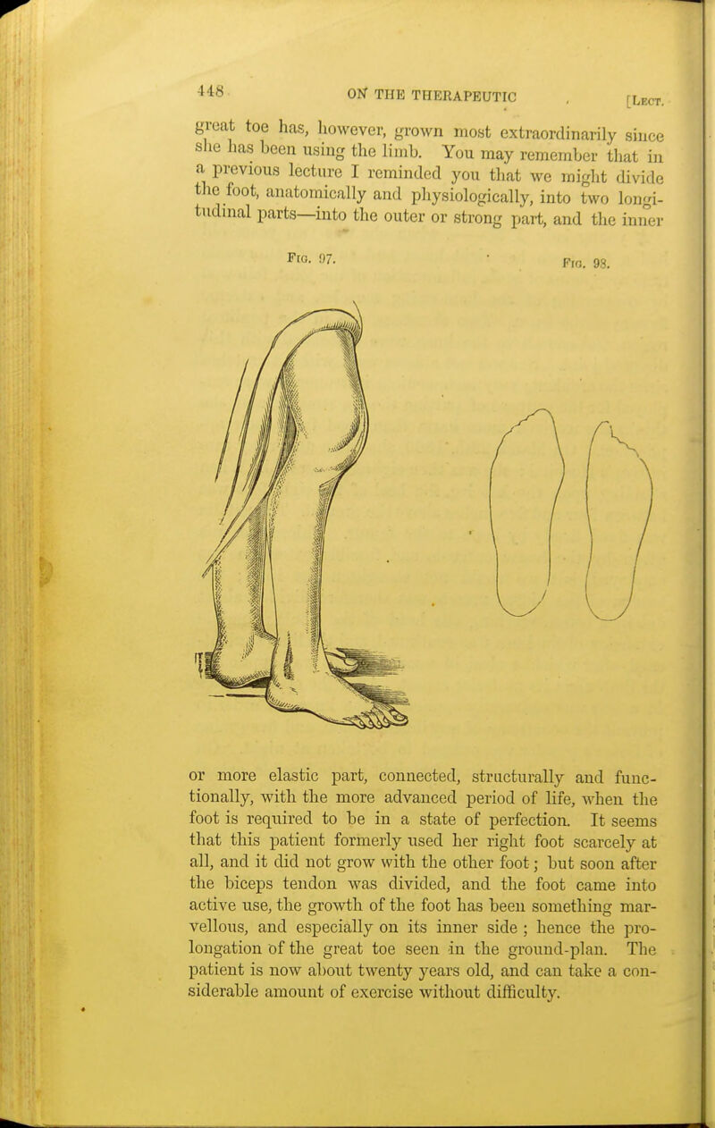 [Lect. great toe has, however, grown most extraordinarily since she has been using the limb. You may remember that in a previous lecture I reminded you that we might divide the foot, anatomically and physiologically, into two longi- tudinal parts—into the outer or strong part, and the inner F[0- • Fro. 98. or more elastic part, connected, structurally and func- tionally, with the more advanced period of life, when the foot is required to be in a state of perfection. It seems that this patient formerly used her right foot scarcely at all, and it did not grow with the other foot; but soon after the biceps tendon was divided, and the foot came into active use, the growth of the foot has been something mar- vellous, and especially on its inner side ; hence the pro- longation of the great toe seen -in the ground-plan. The patient is now about twenty years old, and can take a con- siderable amount of exercise without difficulty.