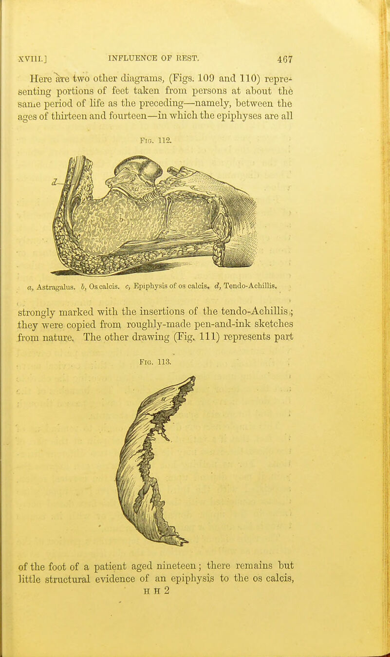 Here ate two other diagrams, (Figs. 109 and 110) repre-1 senting portions of feet taken from persons at about the same period of life as the preceding—namely, between the ages of thirteen and fourteen—in which the epiphyses are all Fig. 112. a, Astragalus, b, Os calcis. c, Epiphysis of os calcis. d, Tendo-Achillis. strongly marked with the insertions of the tendo-Achillis ; they were copied from roughly-made pen-and-ink sketches from nature. The other drawing (Fig. Ill) represents part Fig. 113. of the foot of a patient aged nineteen; there remains but little structural evidence of an epiphysis to the os calcis, h H 2