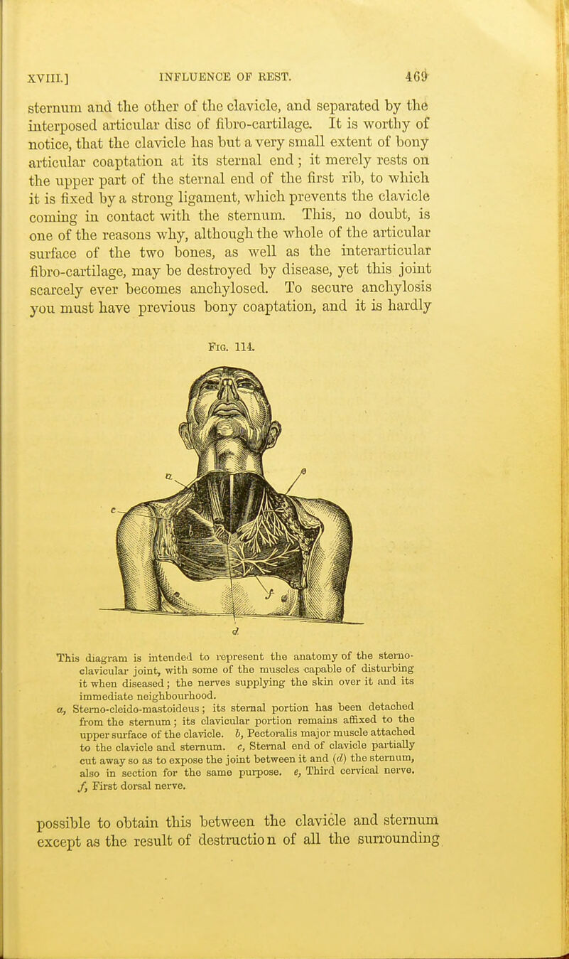 sternum arid the other of the clavicle, and separated by the interposed articular disc of fibro-cartilaga It is worthy of notice, that the clavicle has but a very small extent of bony articular coaptation at its sternal end; it merely rests on the upper part of the sternal end of the first rib, to which it is fixed by a strong ligament, which prevents the clavicle coming in contact with the sternum. This, no doubt, is one of the reasons why, although the whole of the articular surface of the two bones, as well as the interarticular fibro-cartilage, may be destroyed by disease, yet this joint scarcely ever becomes anchylosed To secure anchylosis you must have previous bony coaptation, and it is hardly Fig. 114. This diagram is intended to represent the anatomy of the sterno- clavicular joint, with some of the muscles capable of disturbing it when diseased; the nerves supplying the skin over it and its immediate neighbourhood. a, Stemo-cleido-mastoideus; its sternal portion has been detached from the sternum; its clavicular portion remains affixed to the upper surface of the clavicle, b, Peetoralis major muscle attached to the clavicle and sternum, e, Sternal end of clavicle partially cut away so as to expose the joint between it and (d) the sternum, also in section for the same purpose, e, Third cervical nerve. /, First dorsal nerve. possible to obtain this between the clavicle and sternum except as the result of destruction of all the surrounding