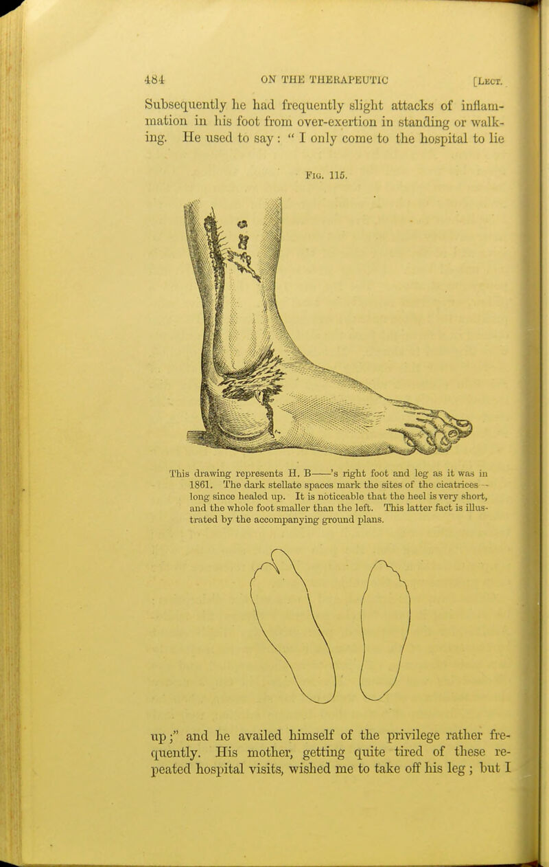 Subsequently he had frequently slight attacks of inflam- mation in his foot from over-exertion in standing or walk- ing. He used to say:  I only come to the hospital to lie Fig. 115. This drawing represents H. B 's right foot and leg as it was in 1861. The dark stellate spaces mark the sites of the cicatrices - long since healed up. It is noticeable that the heel is very short, and the whole foot smaller than the left. This latter fact is illus- trated by the accompanying ground plans. up; and he availed himself of the privilege rather fre- quently. His mother, getting quite tired of these re- peated hospital visits, wished me to take off his leg ; hut I