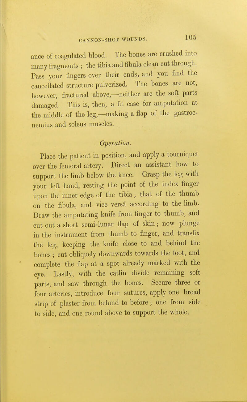 ance of coagulated blood. The bones are crushed into many fragments ; the tibia and fibula clean cut through. Pass your fingers over their ends, and you find the cancellated structure pulverized. The bones are not, however, fractured above,—neither are the soft parts damaged. This is, then, a fit case for amputation at the middle of the leg—making a flap of the gastroc- nemius and soleus muscles. Operation. Place the patient in position, and apply a tourniquet over the femoral artery. Direct an assistant how to support the limb below the knee. Grasp the leg with your left hand, resting the point of the index finger upon the inner edge of the tibia; that of the thumb on the fibula, and vice versa according to the limb. Draw the amputating knife from finger to thumb, and cut oat a short semi-lunar flap of skin; now plunge in the instrument from thumb to finger, and transfix the leg, keeping the knife close to and behind the bones; cut obliquely downwards towards the foot, and complete the flap at a spot already marked with the eye. Lastly, with the catlin divide remaining soft parts, and saw through the bones. Secure three or four arteries, introduce four sutures, apply one broad strip of plaster from behind to before ; one from side to side, and one round above to support the whole.