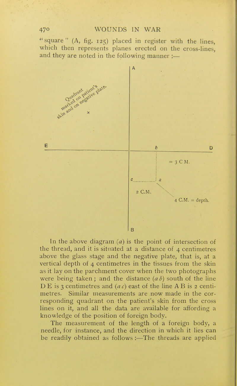 square (A, fig. 125) placed in register with the lines, which then represents planes erected on the cross-lines, and they are noted in the following manner :— A E b D = 3 CM. c . i a 2 CM. 4 CM. = depth. B In the above diagram (a) is the point of intersection of the thread, and it is situated at a distance of 4 centimetres above the glass stage and the negative plate, that is, at a vertical depth of 4 centimetres in the tissues from the skin as it lay on the parchment cover when the two photographs were being taken; and the distance (ad) south of the line D E is 3 centimetres and (ac) east of the line A B is 2 centi- metres. Similar measurements are now made in the cor- responding quadrant on the patient's skin from the cross lines on it, and all the data are available for affording a knowledge of the position of foreign body. The measurement of the length of a foreign body, a needle, for instance, and the direction in which it lies can be readily obtained as follows :—The threads are applied