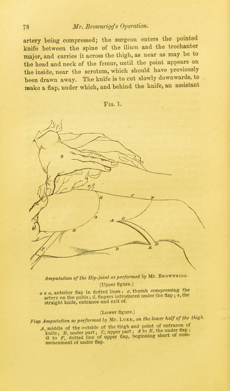 artery being compressed; the surgeon enters the pointed knife between, the spine of the ilium and the trochanter major, and carries it across the thigh, as near as may be to the head and neck of the femur, until the point appears on the inside, near the scrotum, which should have previously been drawn away. The knife is to cut slowly downwards, to make a flap, under which, and behind the knife, an assistant Fio. 1. Amputation of the Hip-joint as performed by Mr. Browwrioc. (Upper figure.) a a a, anterior flap in dotted lines; c. thumb compressing J?' artery on the pubis; d, fingers introduced under the flap; e, the straight knife, entrance and exit of. (Lower figure.) Flap Amputation as performed by Mr. Luke, on the lower half of the thigh. 4, middle of the outside of the thigh and point of^trance.of knife; B, under part; C, upper part ; AtoE, the under flap, a to F, dotted line of upper flap, beginning short of com mencemcnt of under flap.