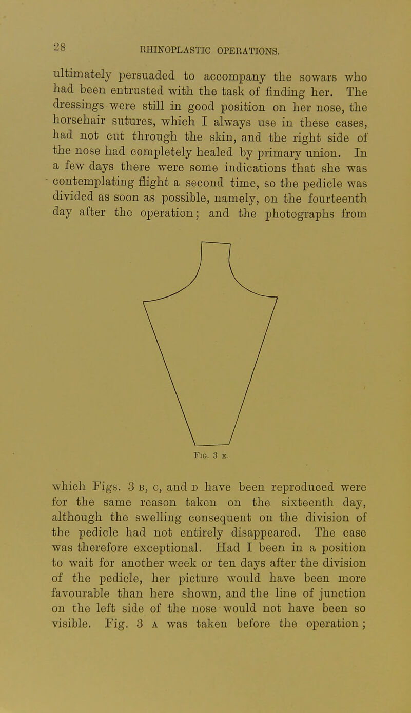 ultimately persuaded to accompany the sowars who had been entrusted with the task of finding her. The dressings were still in good position on her nose, the horsehair sutures, which I always use in these cases, had not cut through the skin, and the right side of the nose had completely healed by primary union. In a few days there were some indications that she was contemplating flight a second time, so the pedicle was divided as soon as possible, namely, on the fourteenth day after the operation; and the photographs from Fig. 3 e. which Figs. 3 b, c, and d have been reproduced were for the same reason taken on the sixteenth day, although the swelling consequent on the division of the pedicle had not entirely disappeared. The case was therefore exceptional. Had I been in a position to wait for another week or ten days after the division of the pedicle, her picture would have been more favourable than here shown, and the line of junction on the left side of the nose would not have been so visible. Fig. 3 a was taken before the operation;