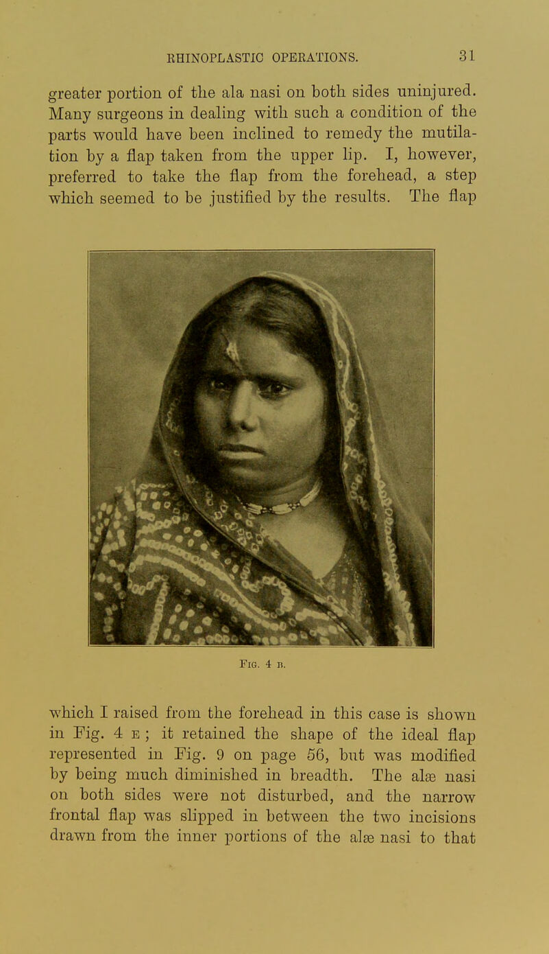 greater portion of the ala nasi on both sides uninjured. Many surgeons in dealing with such a condition of the parts would have been inclined to remedy the mutila- tion by a flap taken from the upper lip. I, however, preferred to take the flap from the forehead, a step which seemed to be justified by the results. The flap Fig. 4 b. which I raised from the forehead in this case is shown in Fig. 4 E ; it retained the shape of the ideal flap represented in Fig. 9 on page 56, but was modified by being much diminished in breadth. The alae nasi on both sides were not disturbed, and the narrow frontal flap was slipped in between the two incisions drawn from the inner portions of the al^ nasi to that