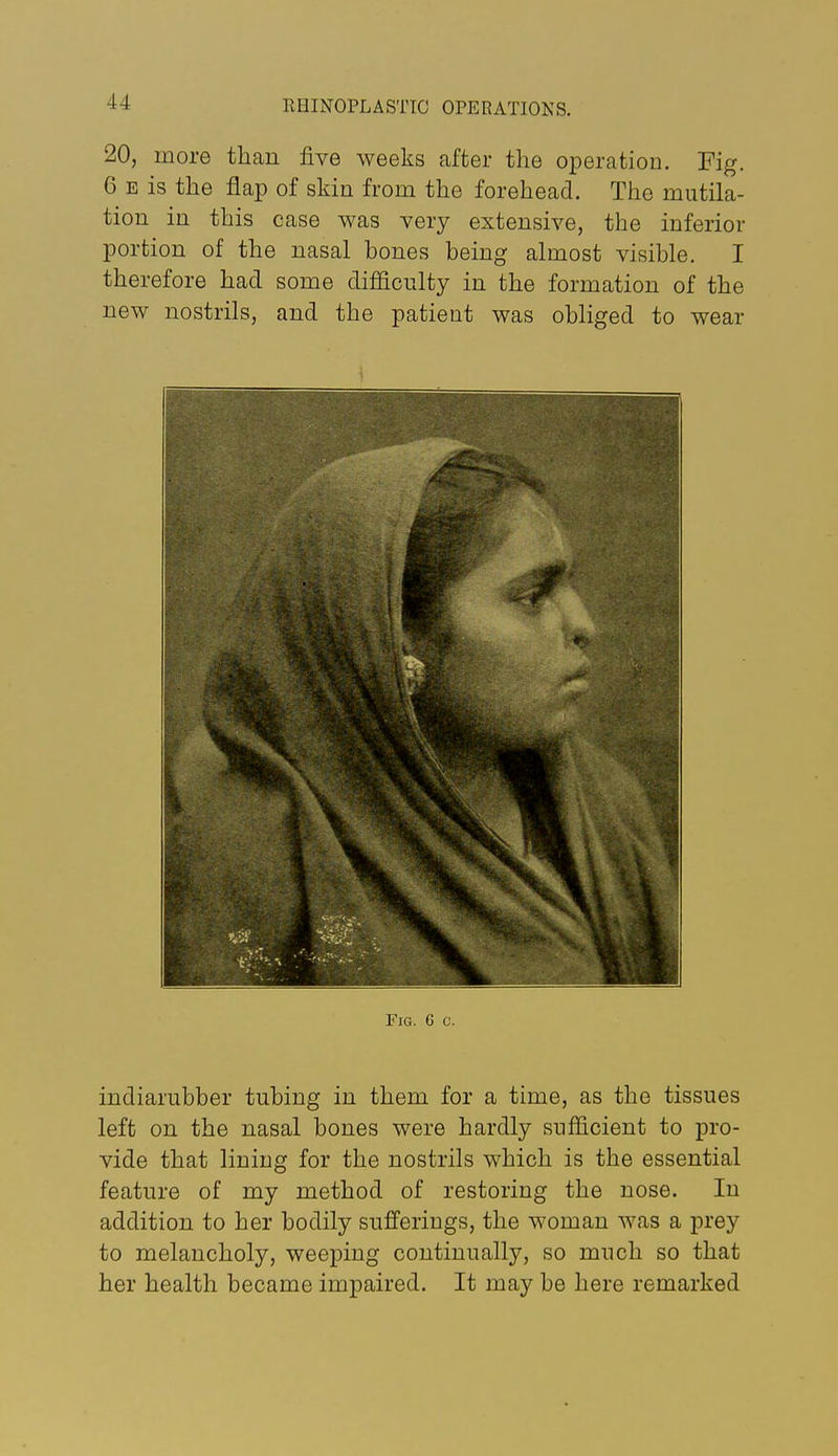 20, more than five weeks after the operatioD. Fig. 6 E is the flap of skin from the forehead. The mutila- tion in this case was very extensive, the inferior portion of the nasal bones being almost visible. I therefore had some difficulty in the formation of the new nostrils, and the patient was obliged to wear Fig. 6 c. indiarubber tubing in them for a time, as the tissues left on the nasal bones were hardly sufficient to pro- vide that lining for the nostrils which is the essential feature of my method of restoring the nose. In addition to her bodily sufferings, the woman was a prey to melancholy, weeping continually, so much so that her health became impaired. It may be here remarked