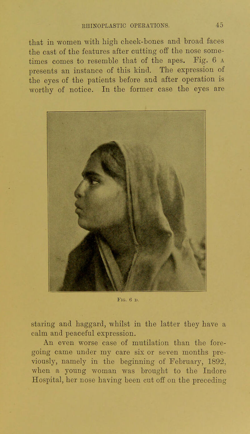 that in women with high cheek-hones and broad faces the cast of the features after cutting off the nose some- times comes to resemble that of the apes. Fig. 6 a presents an instance of this kind. The expression of the eyes of the patients before and after operation is worthy of notice. In the former case the eyes are Fig. 6 d. staring and haggard, whilst in the latter they have a calm and peaceful expression. An even worse case of mutilation than the fore- going came under my care six or seven months pre- viously, namely in the beginning of February, 1892, when a young woman was brought to the Indore Hospital, her nose having been cut off on the preceding