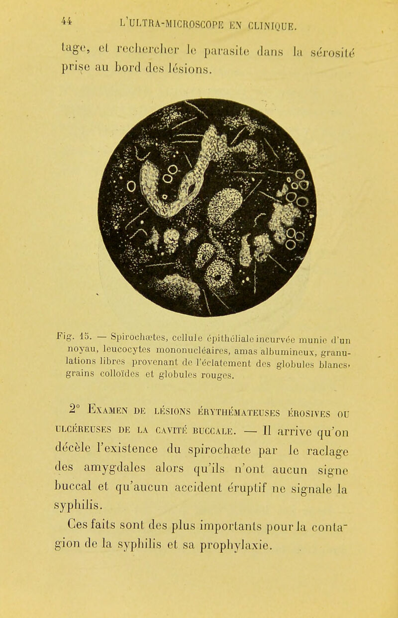 tage, cL r(3clioi-cIicr Ju parasiLc (Jans la sérosité prise au bord des lésions. Fig. 15. — Spirochœtes, cellule épiLhélialoincurvée munie dun noyau, leucocytes mononucléaires, amas albumineux, granu- lations libres provenant de l'éclatement des globules blancs, grains colloïdes et globules rouges. 2° Examen de lésions érythémateuses érosives ou ULCÉREUSES DE LA CAVITÉ BUCCALE. — Il arrive qu'oii décèle l'existence du spirochaete par le raclage des amygdales alors qu'ils n'ont aucun signe buccal et qu'aucun accident éruptif ne signale la syphilis. Ces faits sont des plus importants pour la conla gion de la sypliilis et sa prophylaxie.