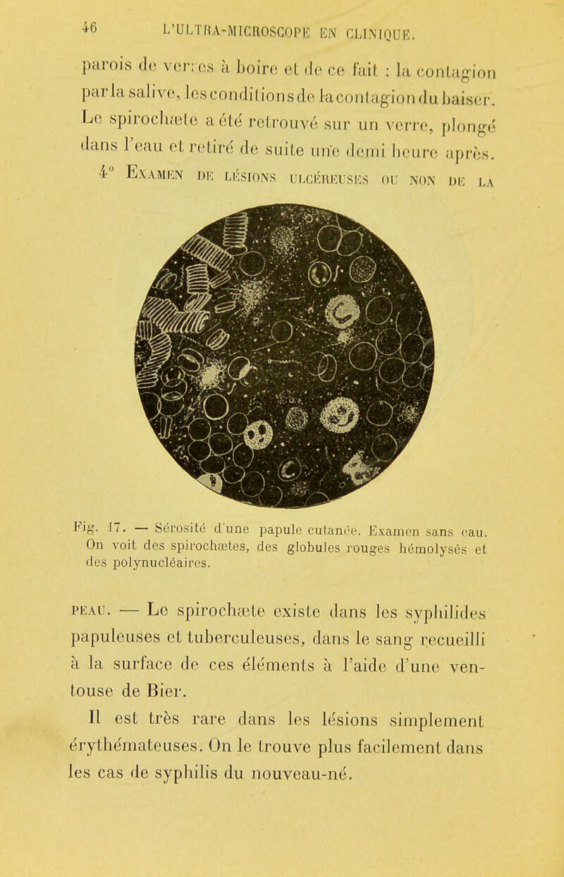 parois de ver: es à boire et de ce fait : la contagion parla salive, les conditions de lacontagion du baiser. Le spirocluete a otë retrouvé sur un verre, plongé dans l'eau et retiré de suite une demi heure après. 4 Examen dk. lésions ulcéreuses ou non ue la Fi^'. 17. — Sérosité d une papule cuLanée. Examen sans eau. On voit des spirochœtes, des globules rouges hémolyses et des polynucléaires. PEAU. — Le spirochtete existe dans les syphilides papuleuses et tuberculeuses, dans le sang recueilli à la surface de ces éléments à l'aide d'une ven- touse de Bier. Il est très rare dans les lésions simplement érythémateuses. On le trouve plus facilement dans les cas de syphilis du nouveau-né.