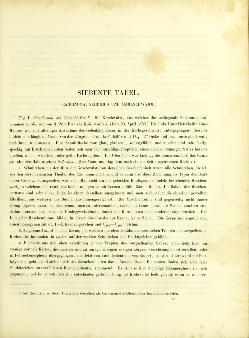 CARCINOMA: SCIRRHUS UND MARKSCHWAMM. Fig. I. Carcinoma des Unterkiefers.* Die Geschwulst, aus welcher die vorliegende Zeichnung ent- nommen wurde, war von H. Prof. Ried exstirpirt worden. (Jena 23. April 1850.) Die linke Unterkieferhälfte eines Mannes war mit alleiniger Ausnahme des Gelenkköpfchens in der Kerbsgeschwulst untergegangen, dieselbe bildete eine längliche Masse von der Länge der Unterkieferhälfte und 1V2—2 Dicke und prominirte gleichzeitig nach innen und aussen. Ihre Schnittfläche war glatt, glänzend, weissgelblich und anscheinend rein fasrig- speckig, auf Druck von beiden Seiten sah man aber unzählige Tröpfchen eines dicken, rahmigen Saftes hervor- quellen, welche weissliche oder gelbe Farbe hatten. Die Oberfläche war knollig, die Consistenz fest, das Ganze gab also den Habitus eines Scirrhus. (Der Mann unterlag dem nach einiger Zeit eingetretenen Recidiv.) a. Schnittchen aus der Mitte der Geschwulst; von derselben Reschaffenheit waren alle Schnitteben, die ich aus den verschiedensten Theilen des Carcinoms machte, und es kann also diese Zeichnung als Typus des Rau's dieser Geschwulst angesehen werden. Man sieht ein aus gelockten Rindegewebsbündeln bestehendes Maschen- werk, in welchem sich rundliche kleine und grosse mit Kernen gefüllte Räume finden. Die Balken des Maschen- gerüstes sind sehr dick; links ist einer derselben ausgefasert und man sieht daher die einzelnen gewellten Fibrillen, aus welchen das Bündel zusammengesetzt ist. Die Maschenräume sind gegenseitig nicht immer streng abgeschlossen, sondern commuuiciren untereinander, sie haben keine besondere Wand, sondern sind dadurch entstanden, dass die Bindegewebsbündel durch die Kernmassen auseinandergedrängt wurden. Den Inhalt der Maschenräume bilden in dieser Geschwulst nur Kerne, keine Zellen. Die Kerne sind rund, haben einen homogenen Inhalt, 1—2 Kernkörper Ghen und —Vaoo' Dehrn. b. Zeigt eine Anzahl solcher Kerne, aus welchen die oben erwähnten weisslichen Tropfen des vorquellenden Krebssaftes bestanden, in zweien auf der rechten Seite haben sich Fcükügelchen gebildet. c. Elemente aus den oben erwähnten gelben Tropfen des vorquellenden Saftes; man sieht hier nur wenige normale Kerne, die meisten sind zu unregelmässigen eckigen Körpern verschrumpft und zerfallen, oder in Fettmetamorphose übergegangen, die letzteren sind bedeulend vergrössert, rund und strotzend mit Fett- kügelchcn gelullt und stellen sich als Körnchenhaufen dar. Ausser diesen Elementen linden sich viele freie Fettkügelchen aus zerfallenen Körnchenhaufen stammend. Es ist also hier diejenige Metamorphose vor sich gegangen, welche gewöhnlich eine entschieden gelbe Färbung des Krebssaftes bedingt und, wenn sie weit ver- * Auf der Tafel ist diese Figur aus Versehen als Carcinom des Oberkiefers bezeichnet worden. 6*