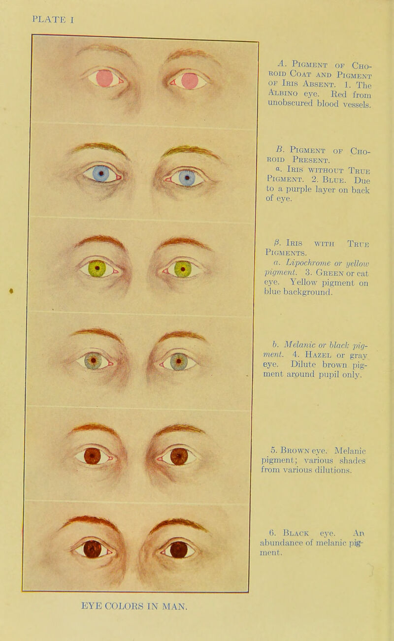 A. Pigment of Cho- roid Coat and Pigment OF Iris Absent. 1. The Albino eye. Red from unobscured blood vessels. B. Pigment of Cho- roid Present. a. Iris without True Pigment. 2. Blue. Due to a purple layer on back of eye. /3. Iris with True Pigments. a. Lipochrome or yelloiv pigment. 3. Green or cat eye. Yellow pigment on blue background. b. Melanic or black pig- me7il. 4. Hazel or gray eye. Dilute brown pig- ment around pupil only. 5. Brown eye. Melanic pigment; various shades from various dilutions. ('). Black eye. .\n abundance of melanic pig- ment. EYE COLORS IN IVIAN.