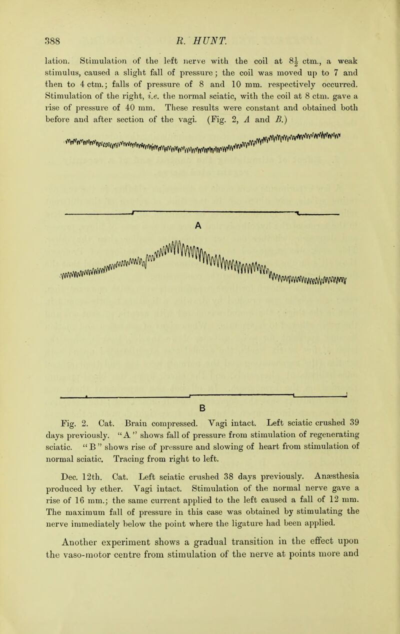 lation. Stimulation of the left nerve with the coil at 8£ ctm., a weak stimulus, caused a slight fall of pressure; the coil was moved up to 7 and then to 4 ctm.; falls of pressure of 8 and 10 mm. respectively occurred. Stimulation of the right, i.e. the normal sciatic, with the coil at 8 ctm. gave a rise of pressure of 40 mm. These results were constant and obtained both before and after section of the vagi. (Fig. 2, A and B.) B Fig. 2. Cat. Brain compressed. Vagi intact. Left sciatic crushed 39 days previously.  A  shows fall of pressure from stimulation of regenerating sciatic. B shows rise of pressure and slowing of heart from stimulation of normal sciatic. Tracing from right to left. Dec. 12th. Cat. Left sciatic crushed 38 days previously. Anaesthesia produced by ether. Vagi intact. Stimulation of the normal nerve gave a rise of 16 mm.; the same current applied to the left caused a fall of 12 mm. The maximum fall of pressure in this case was obtained by stimulating the nerve immediately below the point where the ligature had been applied. Another experiment shows a gradual transition in the effect upon the vaso-motor centre from stimulation of the nerve at points more and