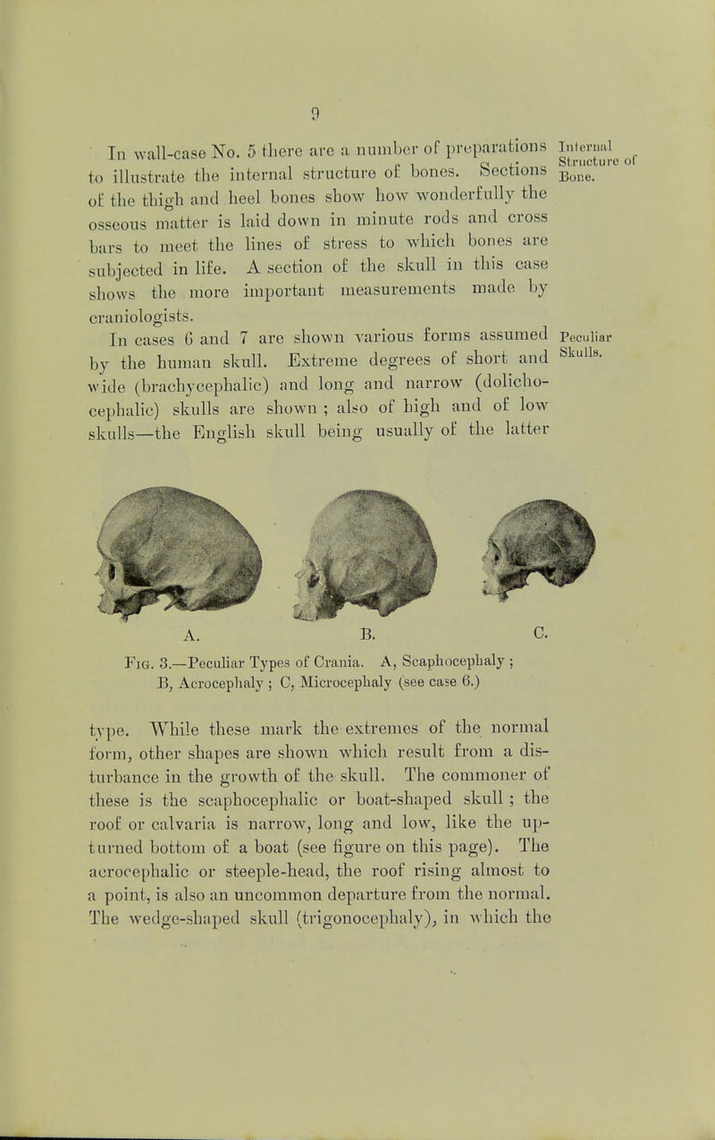 In wall-case No. 5 there are a number of preparations Internal to illustrate the internal structure of bones. Sections B™°ur of the thigh and heel bones show how wonderfully the osseous matter is laid down in minute rods and cross bars to meet the lines of stress to which bones are subjected in life. A section of the skull in this case shows the more important measurements made by craniologists. In cases G and 7 are shown various forms assumed Peculiar by the human skull. Extreme degrees of short and Skulls- wide (brachy cephalic) and long and narrow (dolicho- cephalic) skulls are shown ; also of high and of low s]culls—the English skull being usually of the latter Fig. 3.—Peculiar Types of Crania. A, Scaphocephaly ; B, Acrocephaly ; C, Microcephaly (see case 6.) type. While these mark the extremes of the normal form, other shapes are shown which result from a dis- turbance in the growth of the skull. The commoner of these is the scaphocephaly or boat-shaped skull ; the roof or calvaria is narrow, long and low, like the up- turned bottom of a boat (see figure on this page). The acrocephalic or steeple-head, the roof rising almost to a point, is also an uncommon departure from the normal. The wedge-shaped skull (trigonocephaly), in which the