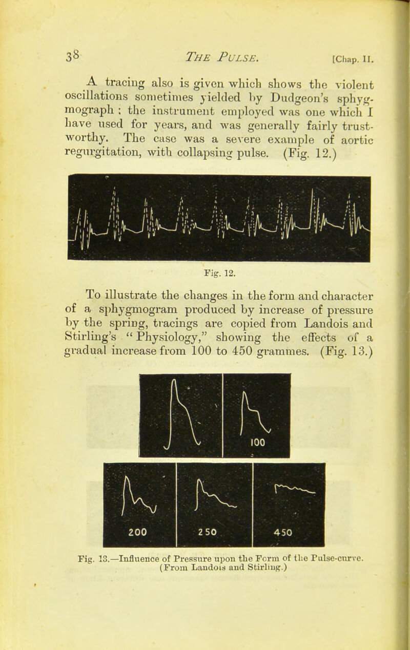 A tracing also is given which shows the violent oscillations sometimes yielded by Dudgeon's sphyg- mograph ; the instrument employed was one which I have used for years, and was generally fairly trust- worthy. The case was a severe example of aortic regurgitation, with collapsing pulse. (Fig. 12.) Fig. 12. To illustrate the changes in the form and character of a sphygmogram produced by increase of pressure by the spring, tracings are copied from Landois and Stirling's  Physiology, showing the effects of a (Fig. 13.) gradual increase from 100 to 450 grammes Fig. 13.—Influence of Pressure upon the Form of the Fulse-cnrve. (From Landois and Stirling.)