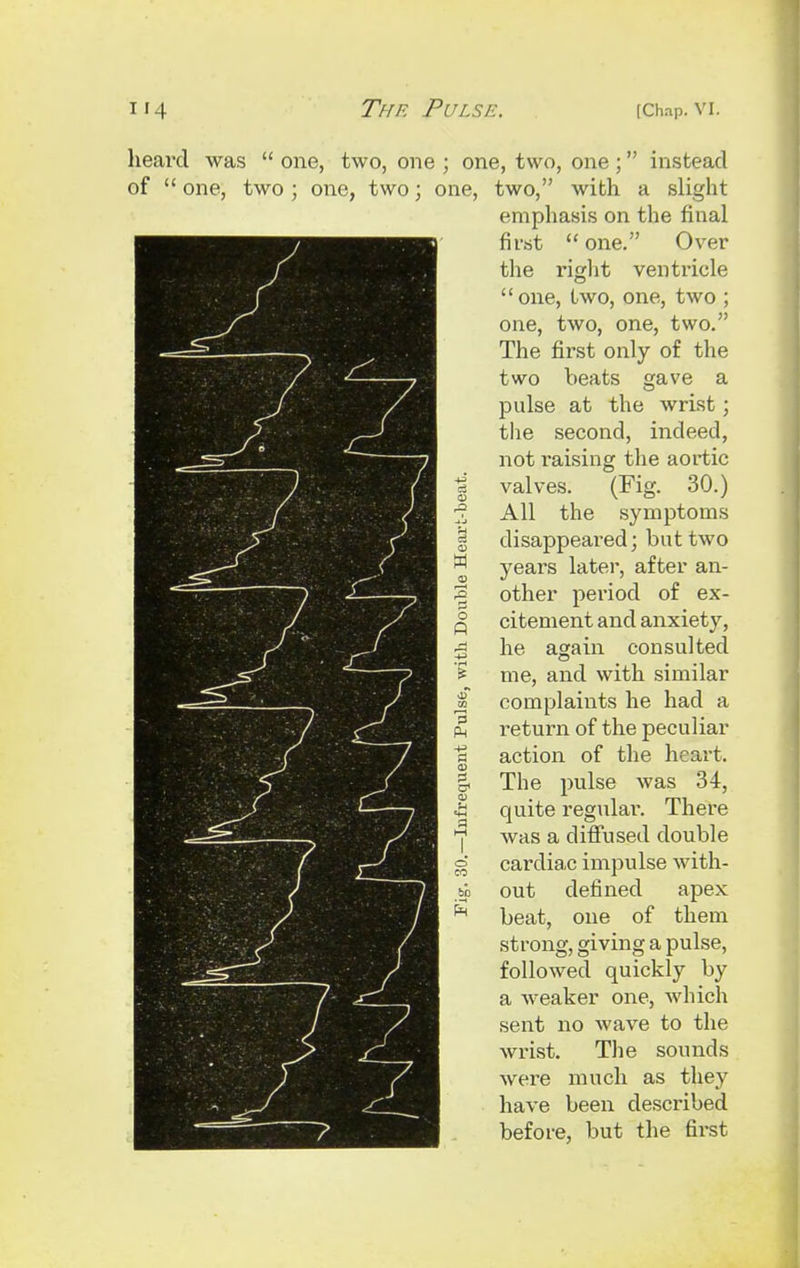 heard was  one, two, one ; one, two, one; instead of  one, two ; one, two; one, two, with a slight emphasis on the final first  one. Over the right ventricle one, two, one, two ; one, two, one, two. The first only of the two beats gave a pulse at the wrist; the second, indeed, not raising the aortic valves. (Fig. 30.) All the symptoms disappeared; but two years later, after an- other period of ex- citement and anxiety, he again consulted me, and with similar complaints he had a l-eturn of the peculiar action of the heart. The pulse was 34, quite regular. There was a diffused double cardiac impulse with- out defined apex beat, one of them strong, giving a pulse, followed quickly by a weaker one, which sent no wave to the wrist. The sounds were much as they have been described before, but the first o p 3 bo