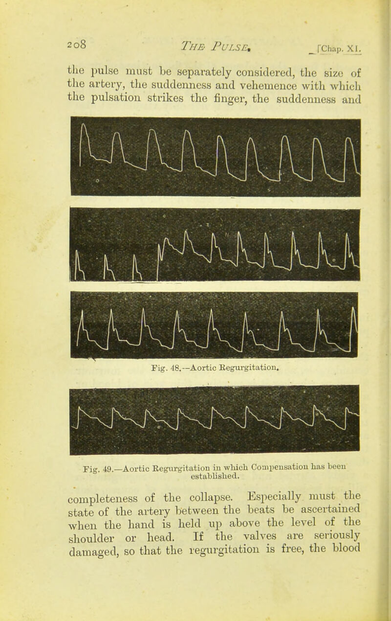 the pulse must be separately considered, the size of the artery, the suddenness and vehemence with which the pulsation strikes the finger, the suddenness and 1 ■ 1 1 ■ Fig. 48. —Aortic Regurgitation. Fig. 49.—Aortic Regurgitation in which Compensation has been established. completeness of the collapse. Especially must the state of the artery between the beats be ascertained when the hand is held up above the level of the shoulder or head. If the valves are seriously damaged, so that the regurgitation is free, the blood