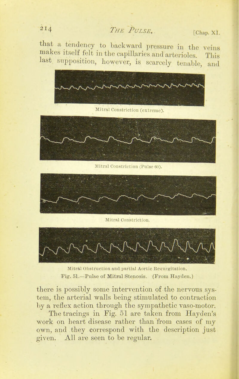 I Chap. XI. that a tendency to backward pressure in the veins makes itself felt in the capillaries and arterioles. Tin's last supposition, however, is scarcely tenable, and Mitral Constriction (Pulse 60). Mitral Constriction. Mitral Obstruction and partial Aortic Regurgitation. Fig. 51.—Pulse of Mitral Stenosis. (From Hayden.) there is possibly some intervention of the nervous sys- tem, the arterial walls being stimulated to contraction by a reflex action through the sympathetic vaso-motor. The tracings in Fig. 51 are taken from Hay den's work on heart disease rather than from cases of my own, and they correspond with the description just given. All are seen to be regular.